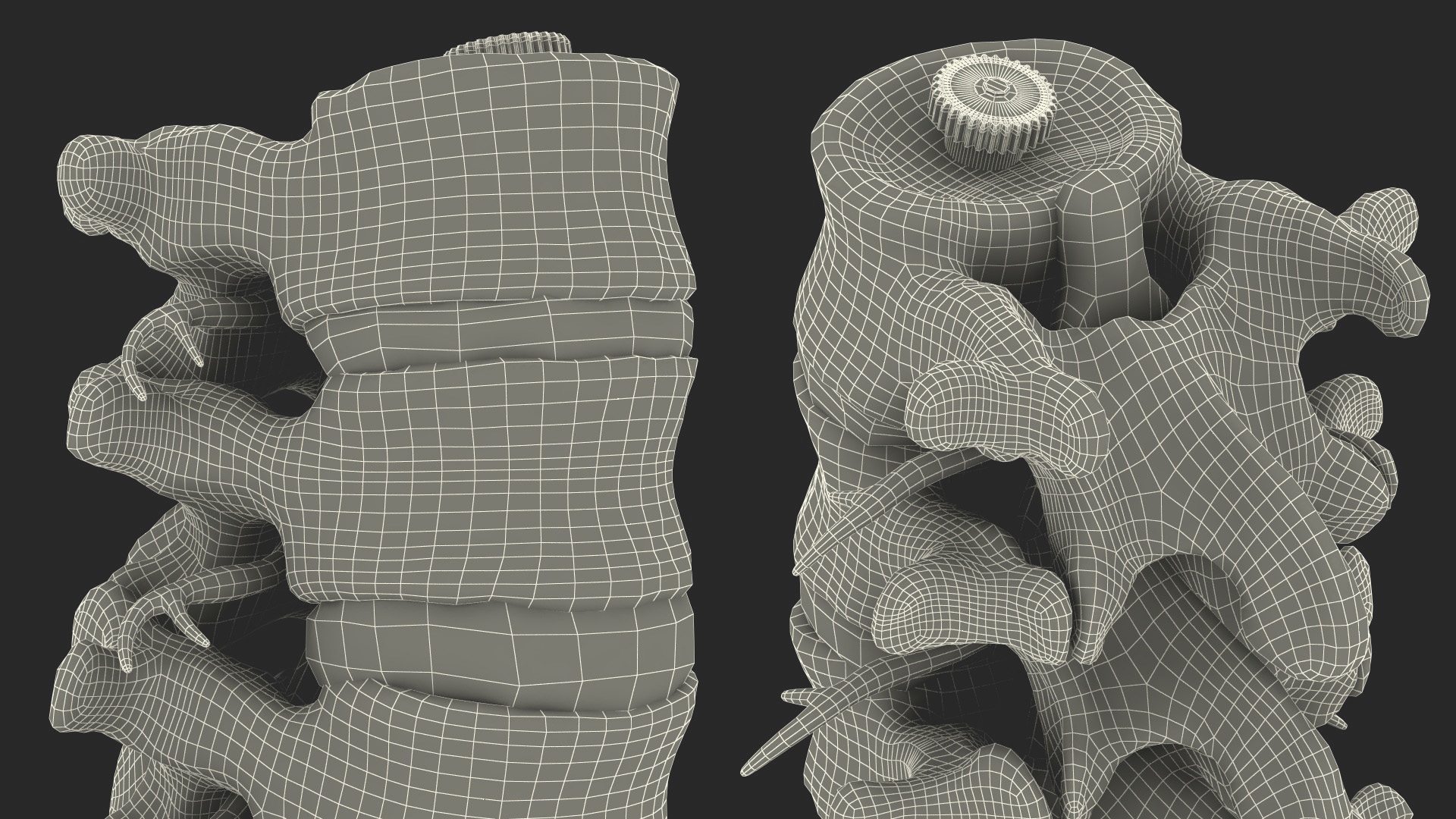 Spinal Column with Hernia on Stand 3D model