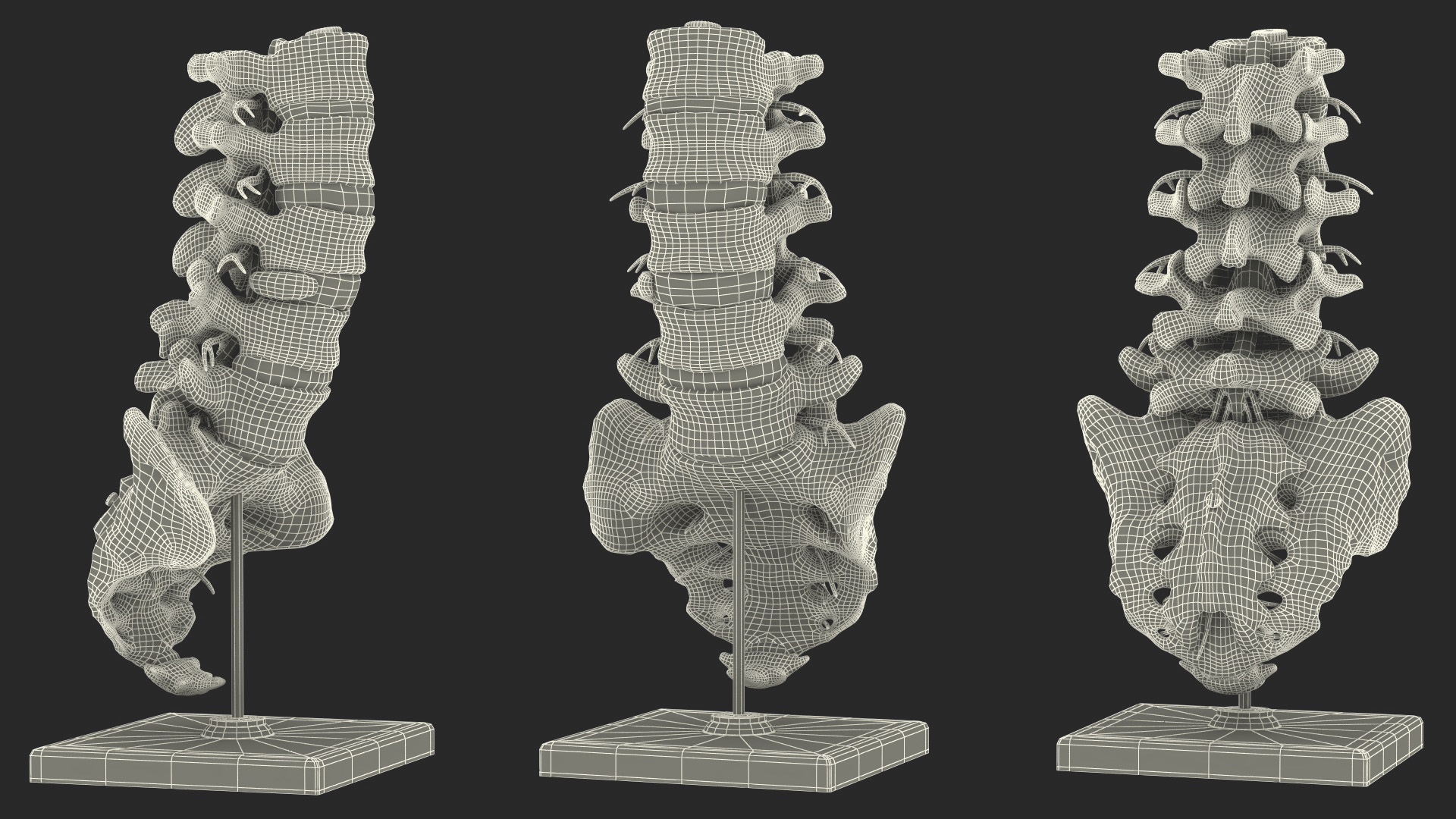 Spinal Column with Hernia on Stand 3D model