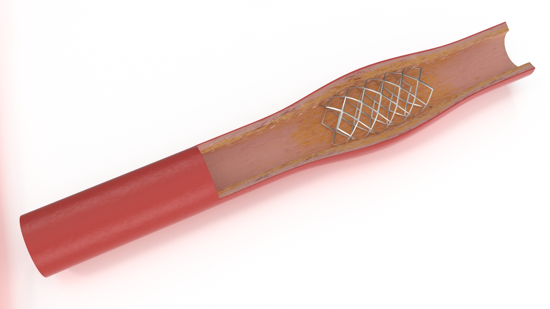3D Stents with Artery model