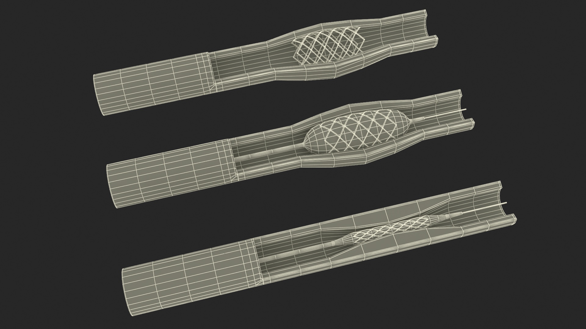 3D Stents with Artery model