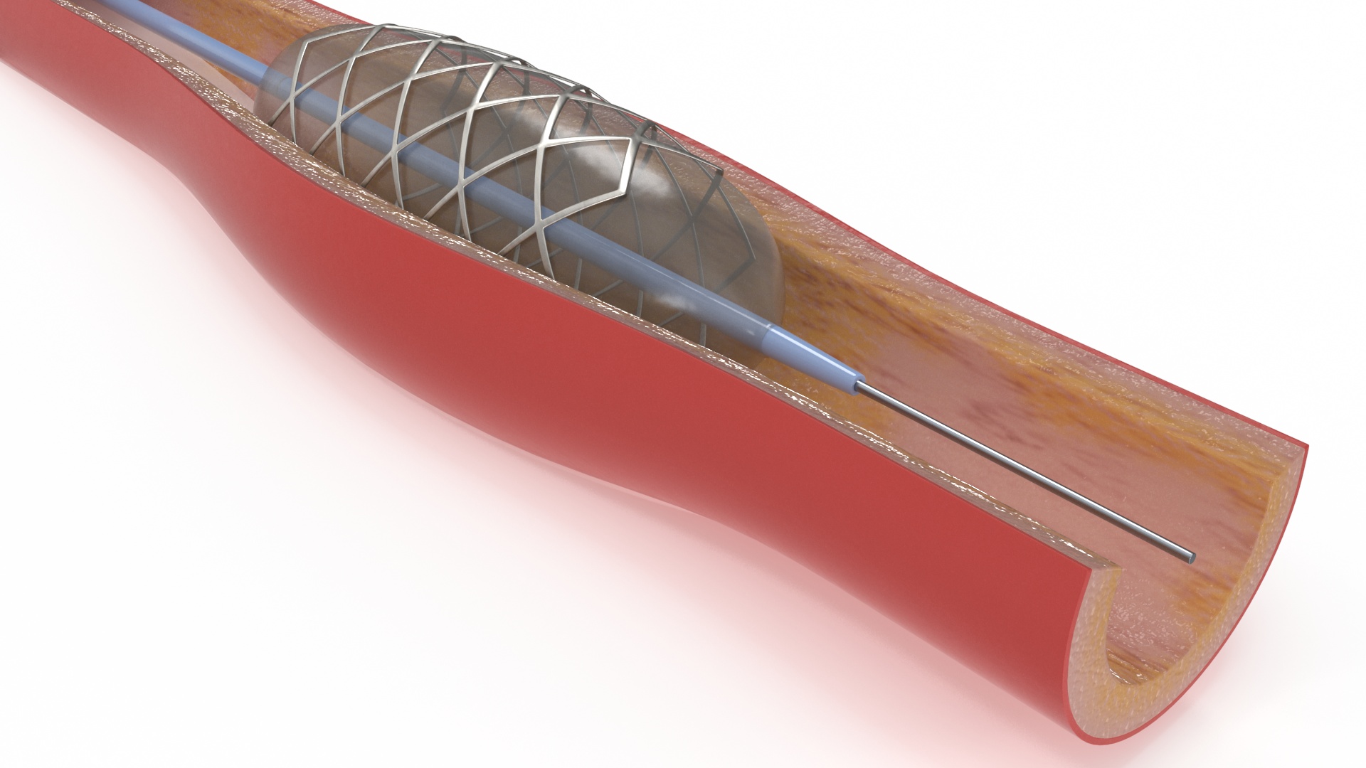 3D Stents with Artery model
