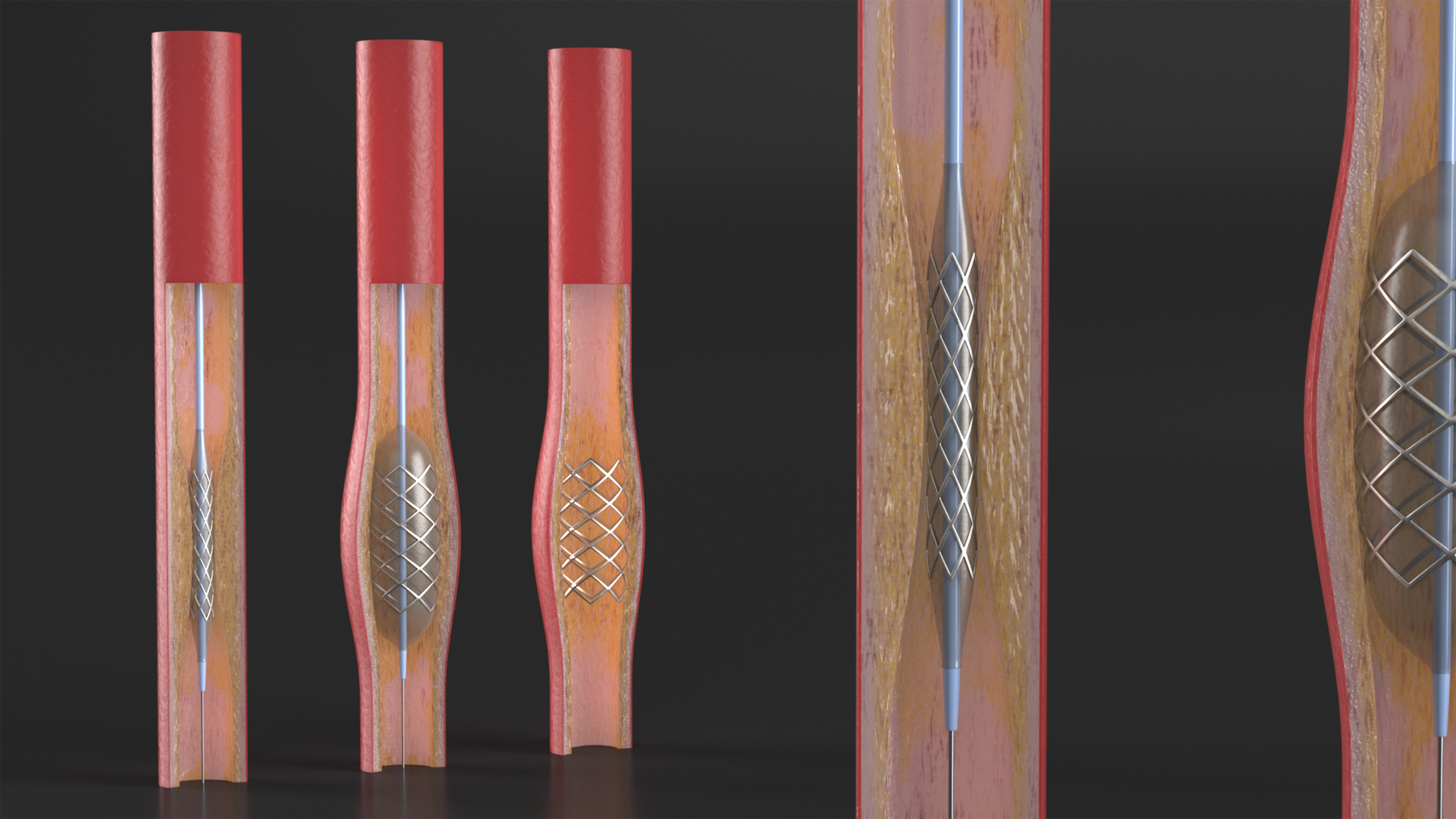 3D Stents with Artery model