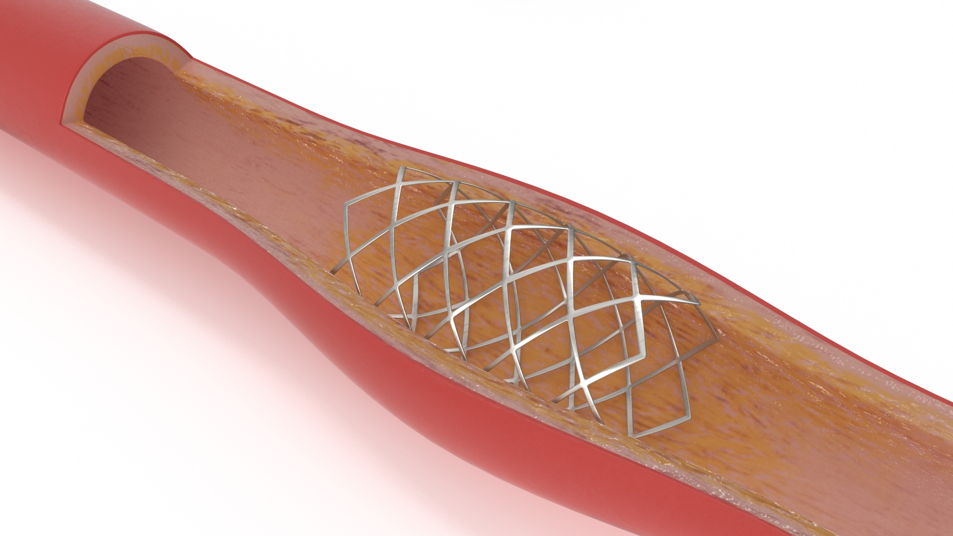 3D Stents with Artery model
