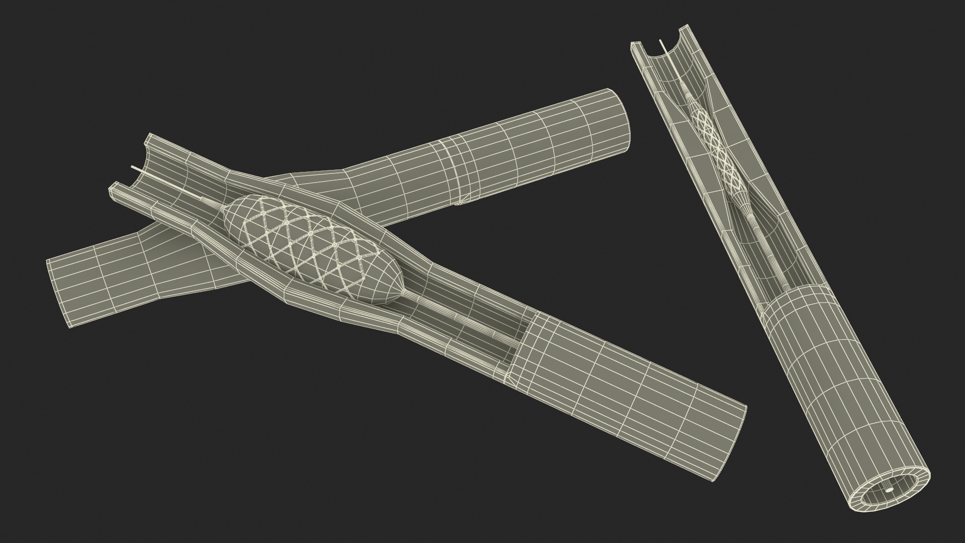 3D Stents with Artery model