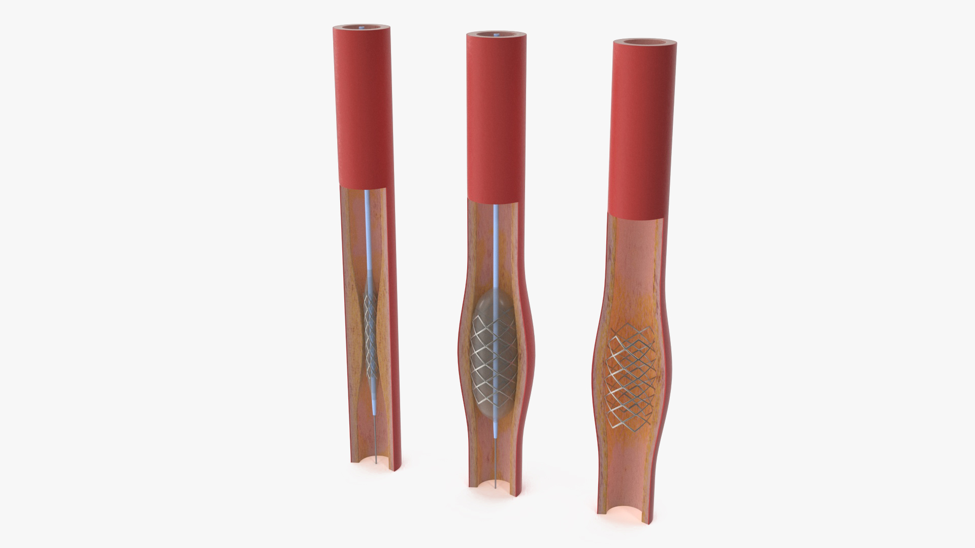 3D Stents with Artery model