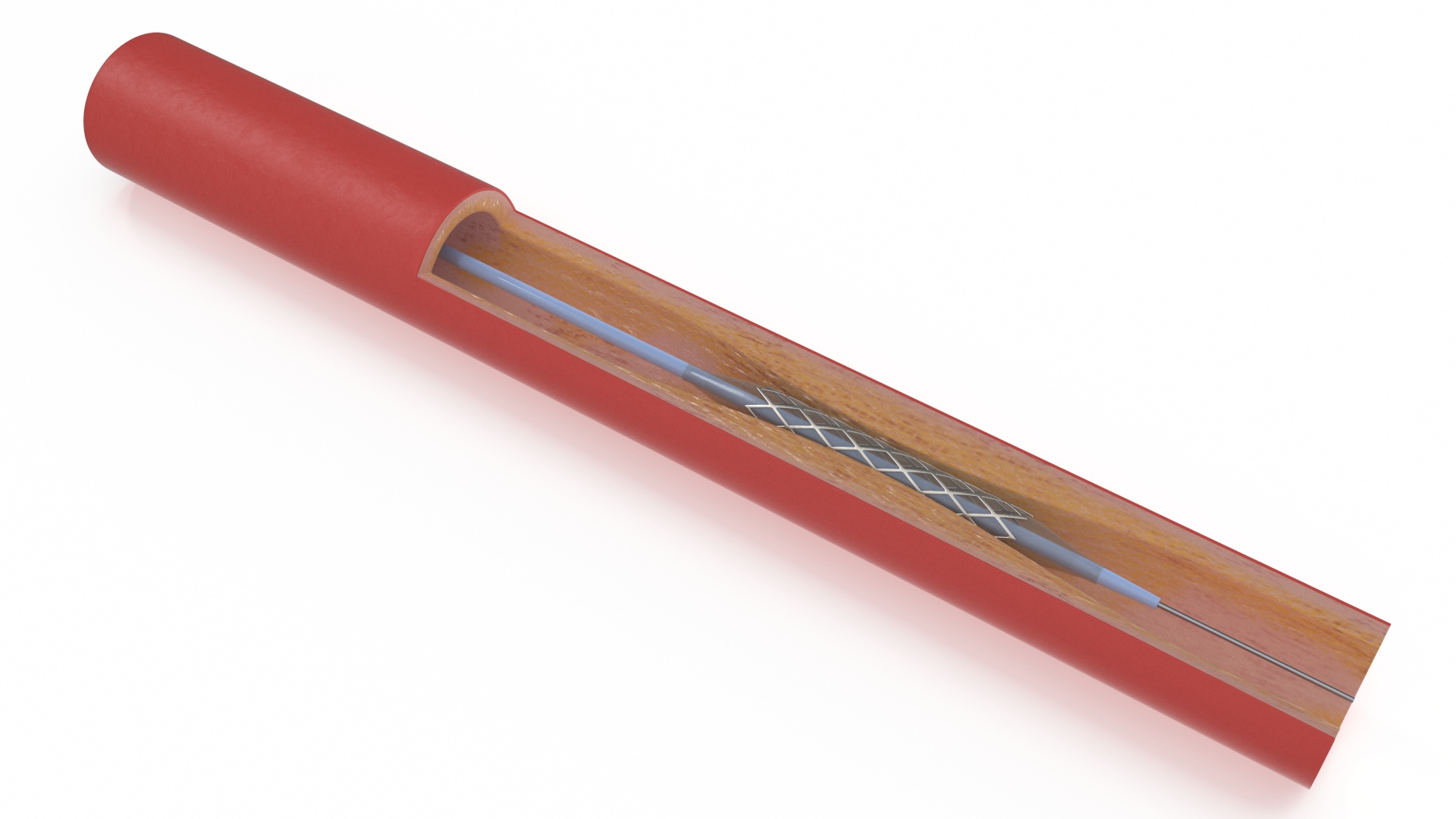 3D Stents with Artery model