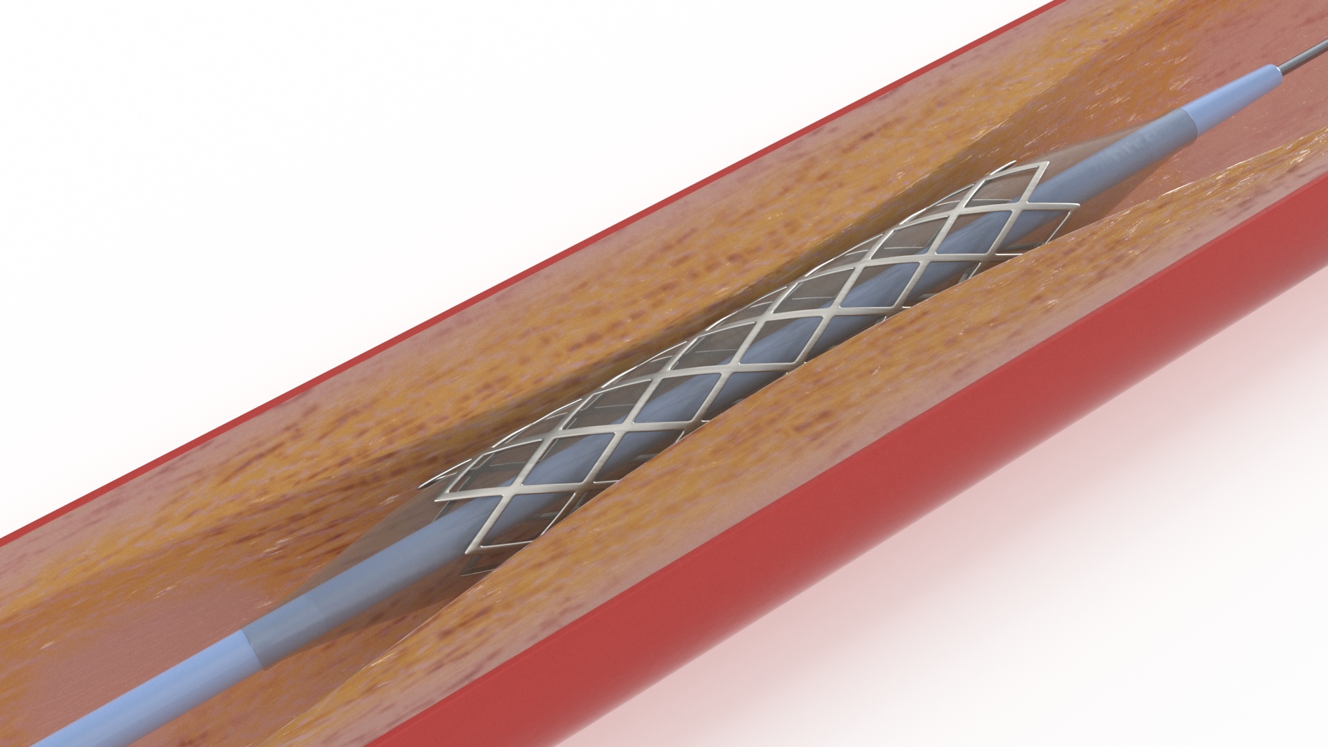 3D Stents with Artery model