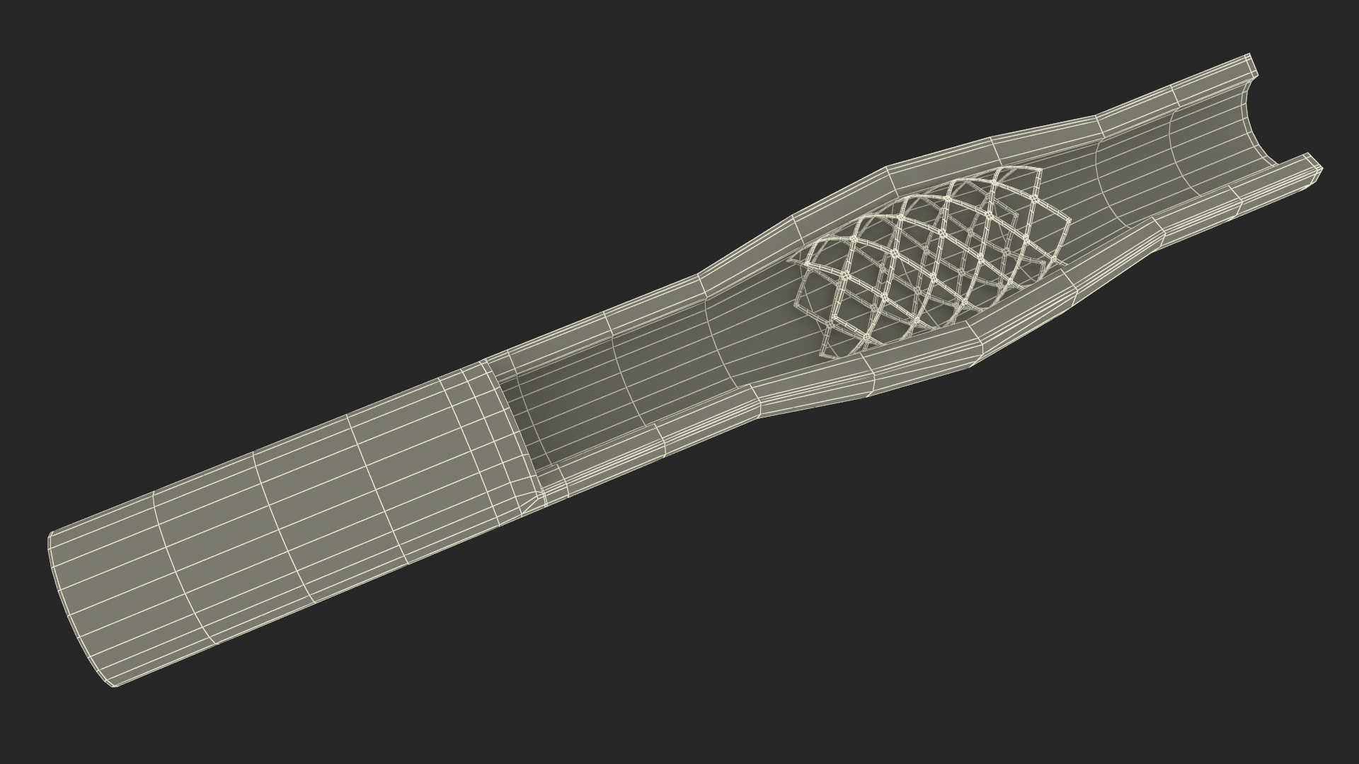 3D Stents with Artery model