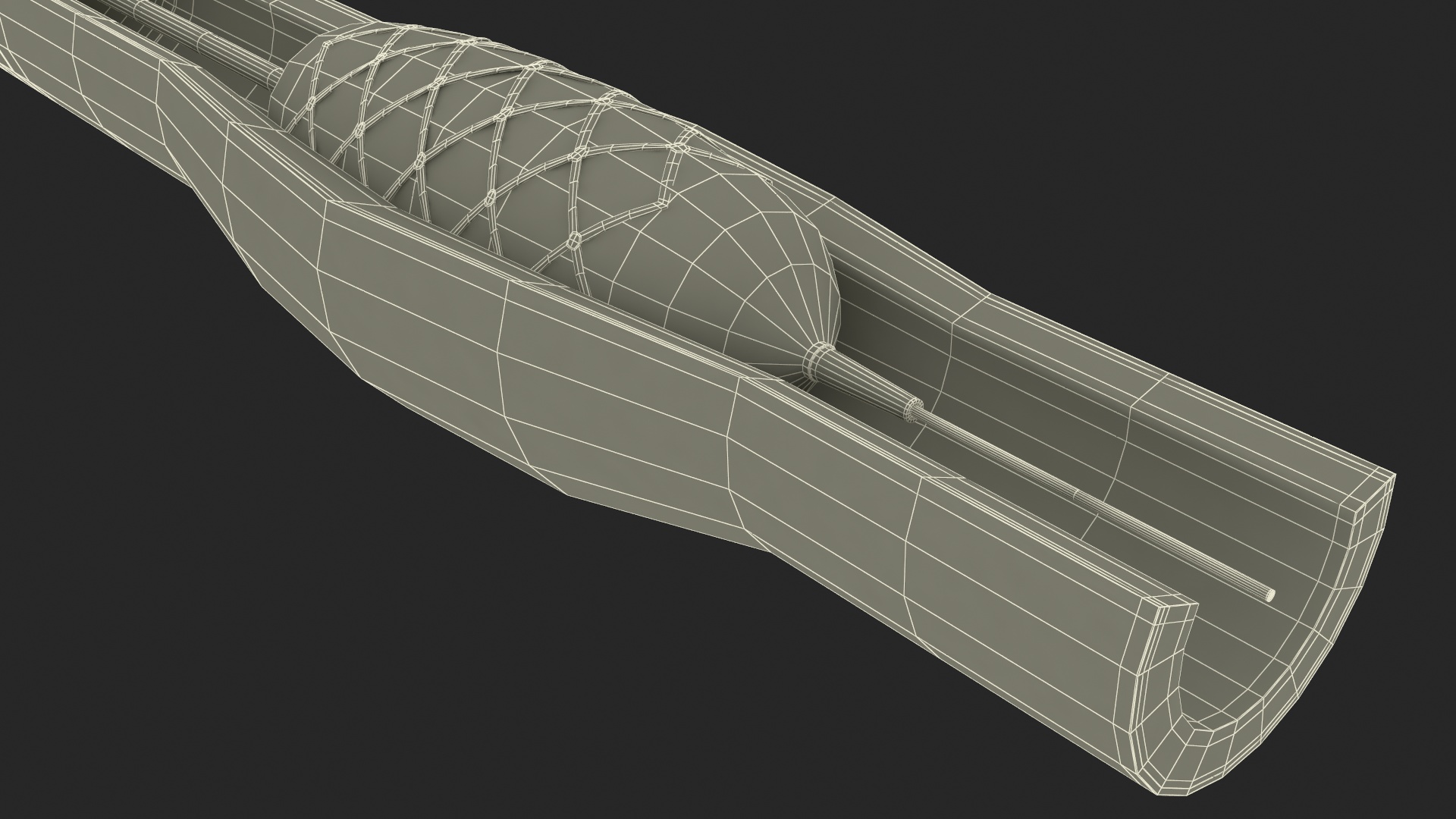 3D Stents with Artery model