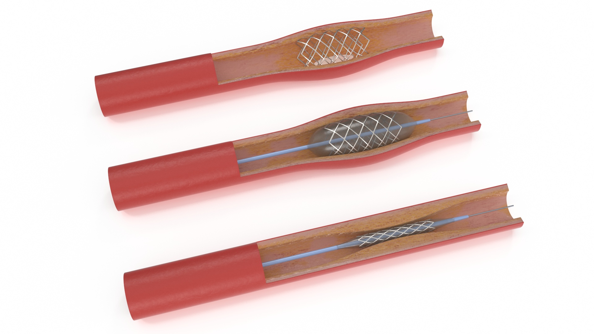 3D Stents with Artery model