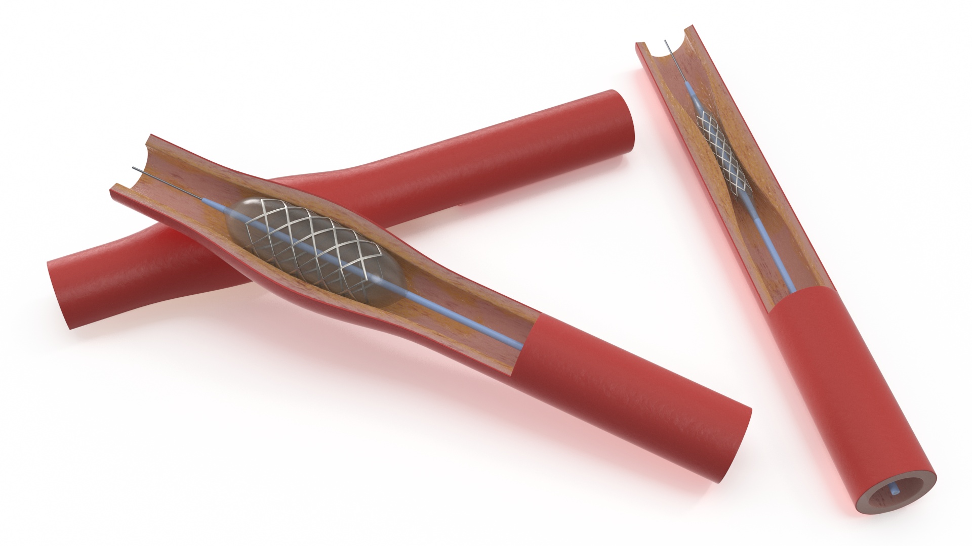 3D Stents with Artery model