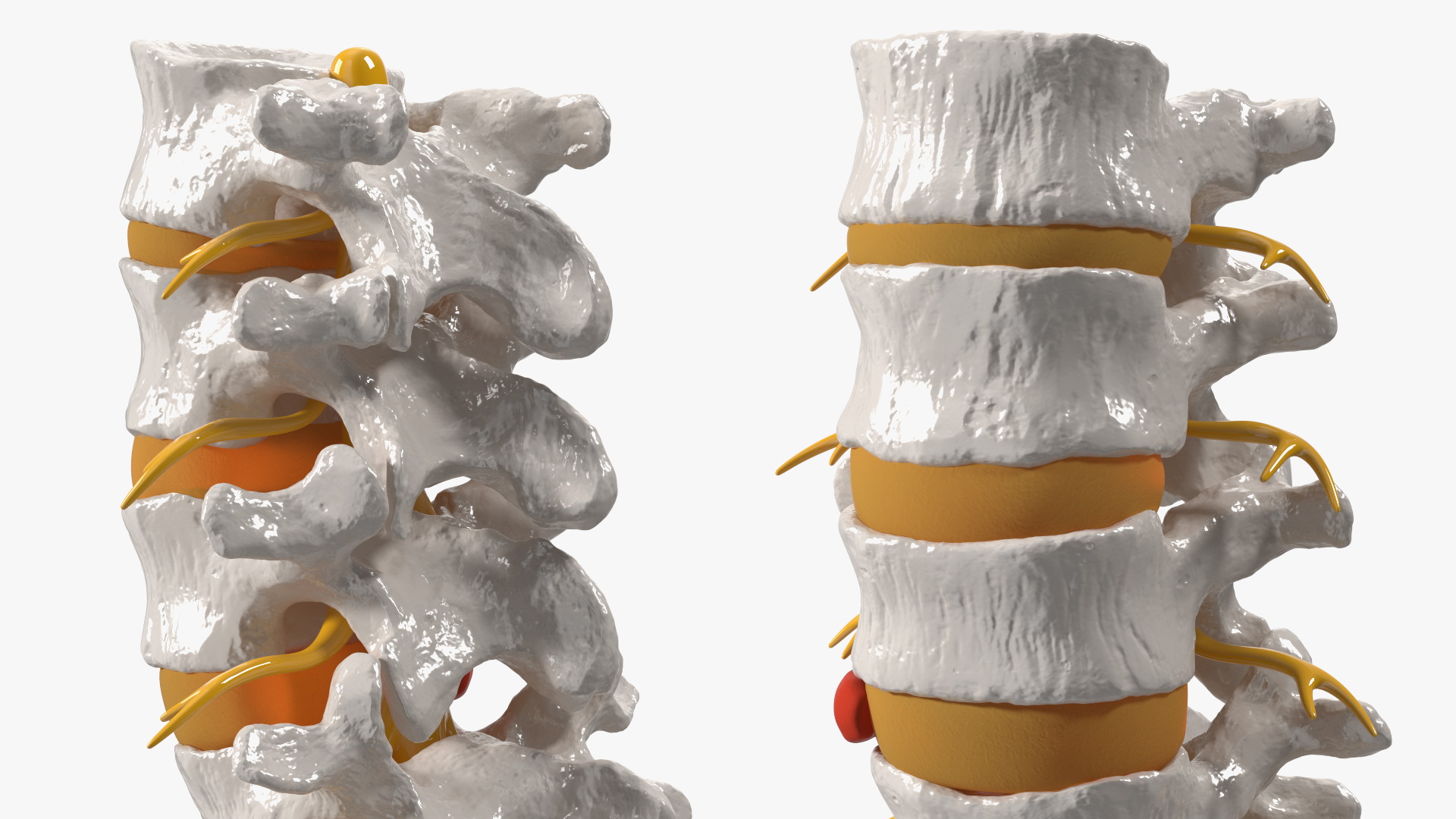 3D model Spinal Column with Hernia