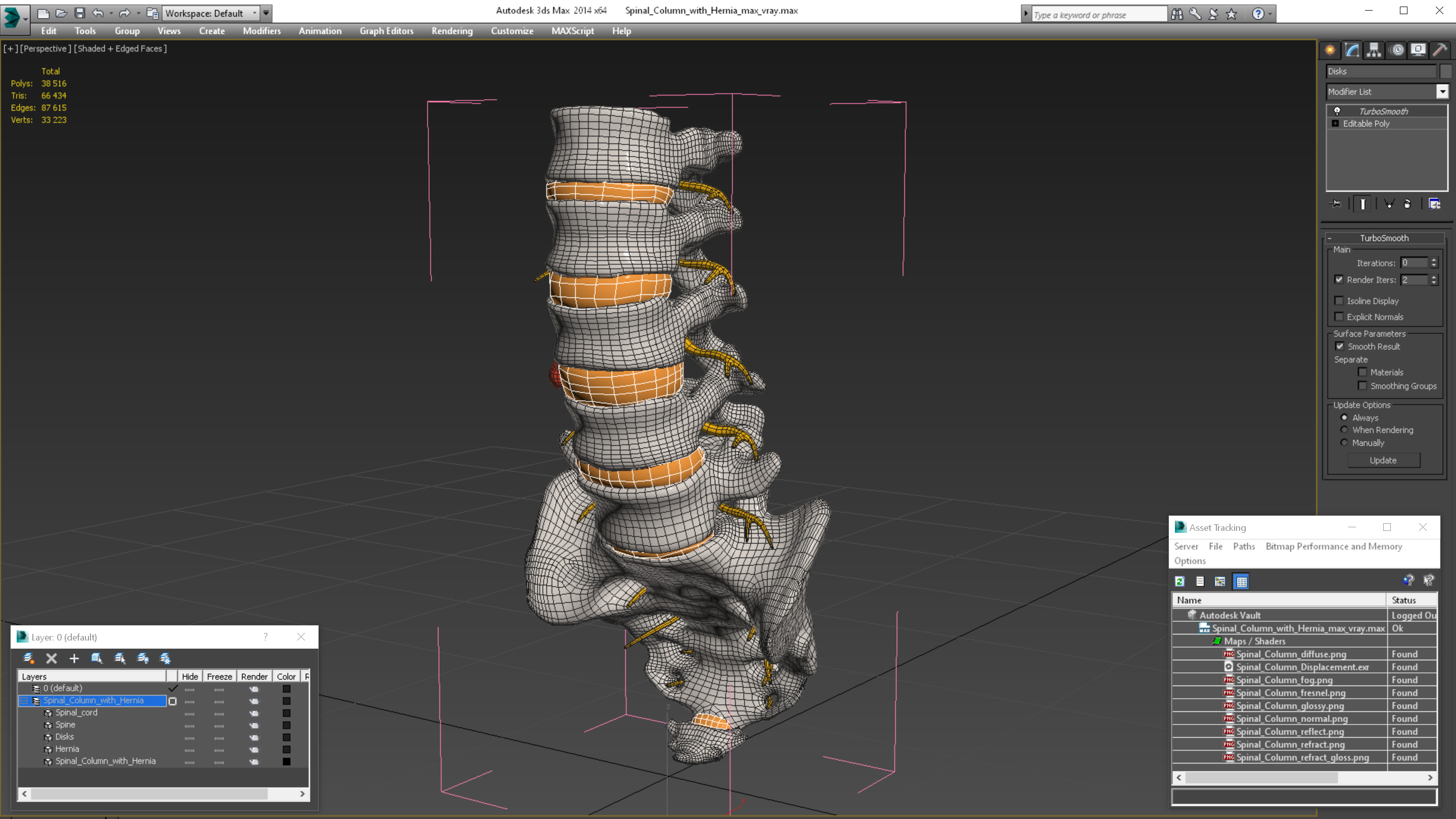 3D model Spinal Column with Hernia
