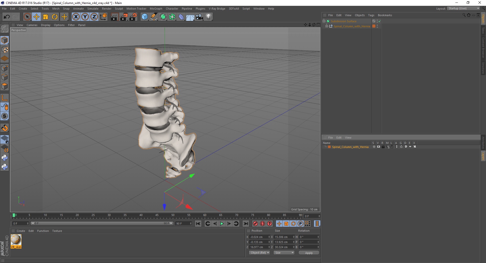 3D model Spinal Column with Hernia