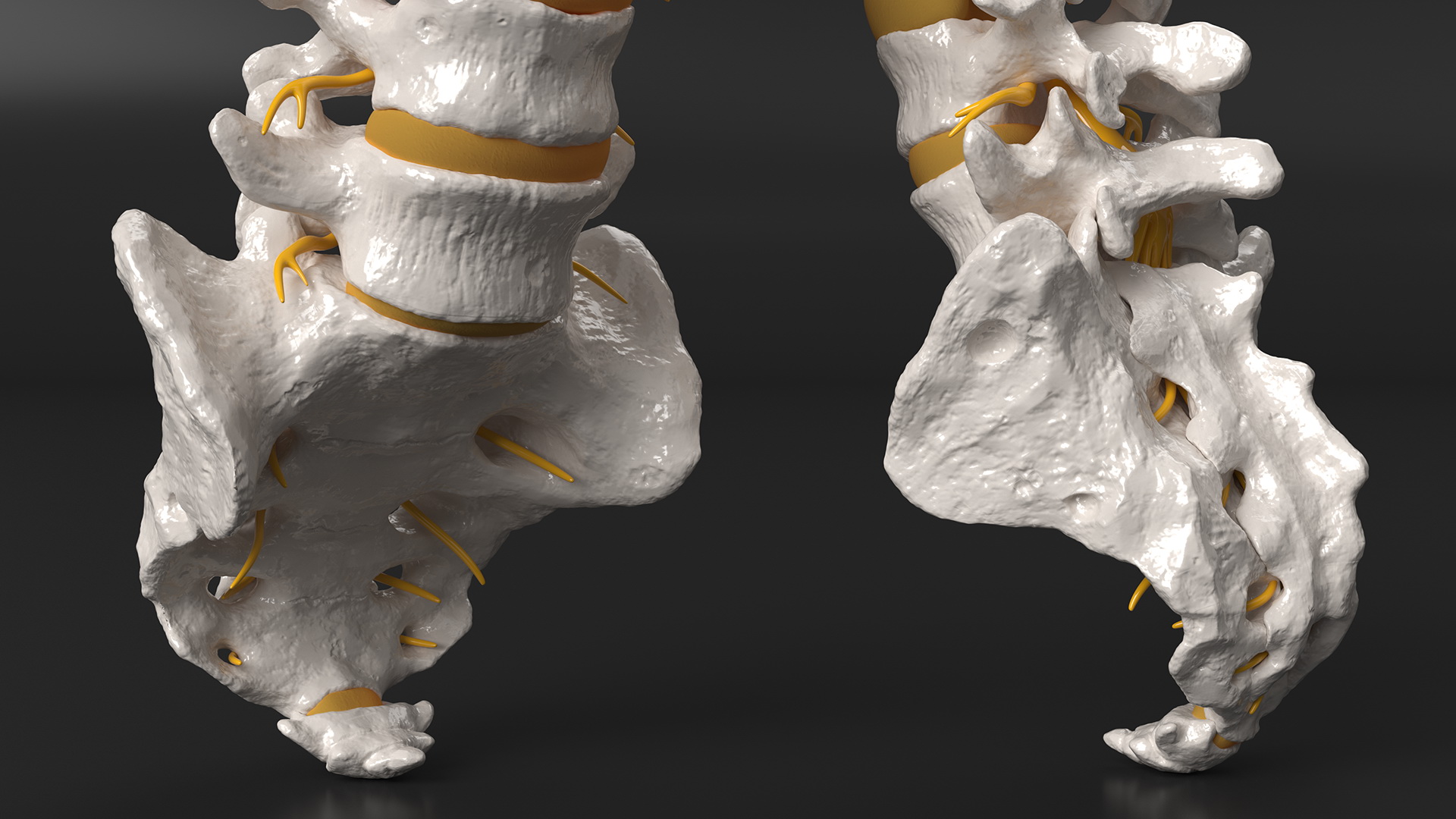 3D model Spinal Column with Hernia