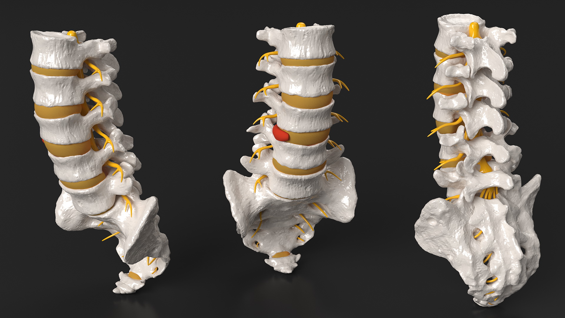 3D model Spinal Column with Hernia