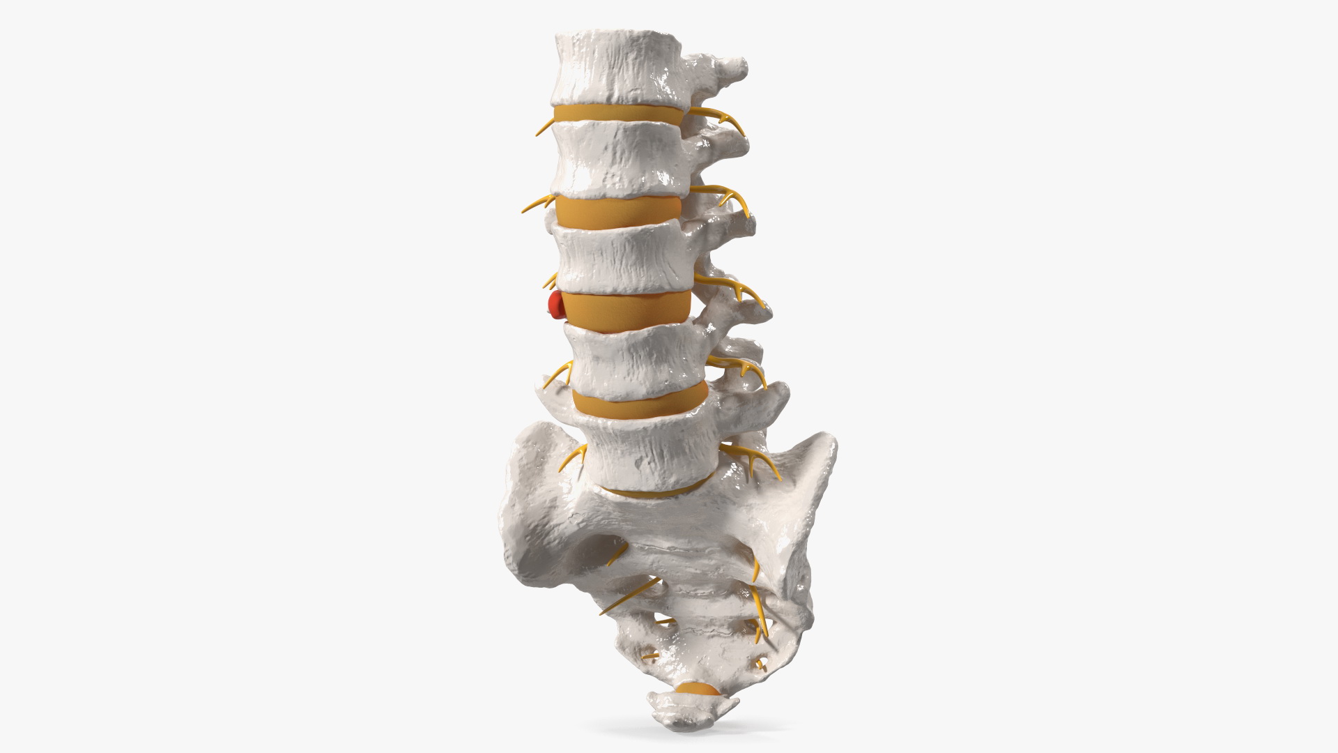 3D model Spinal Column with Hernia