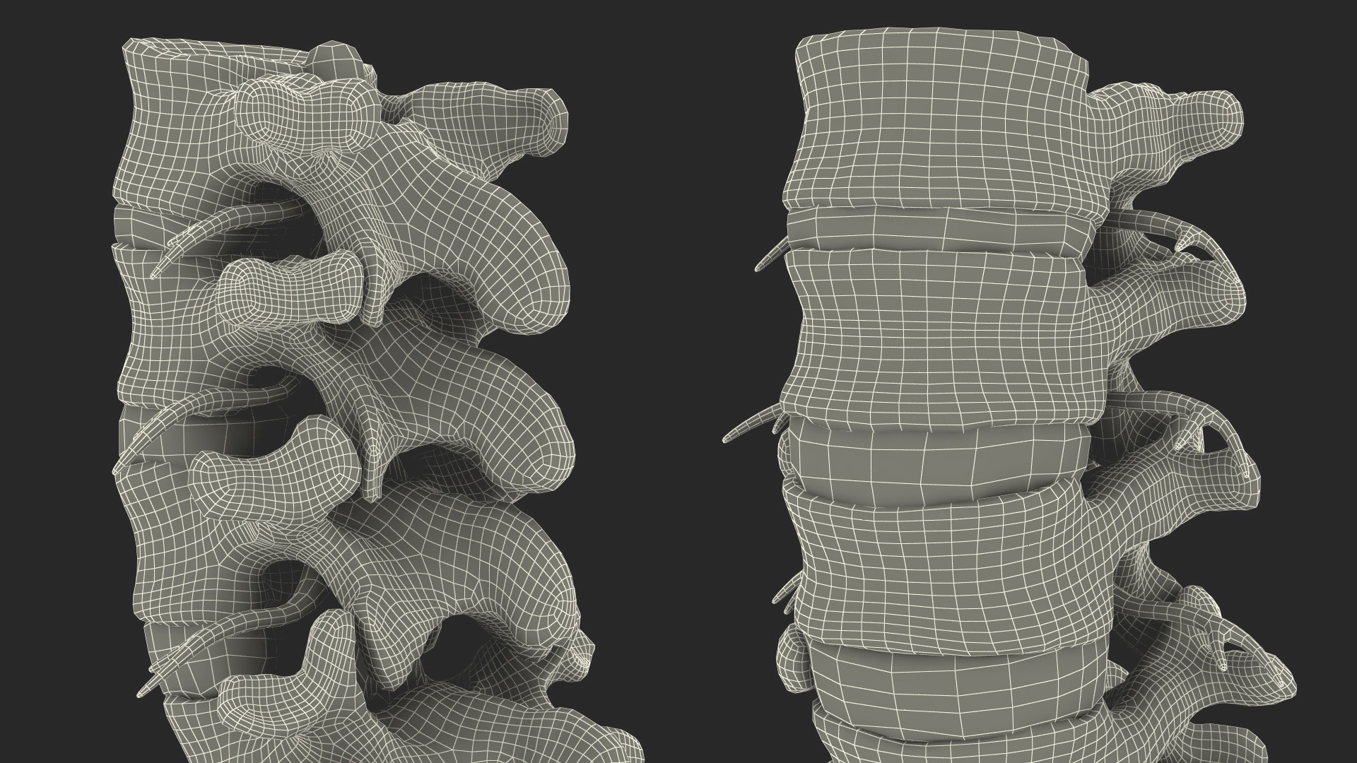 3D model Spinal Column with Hernia