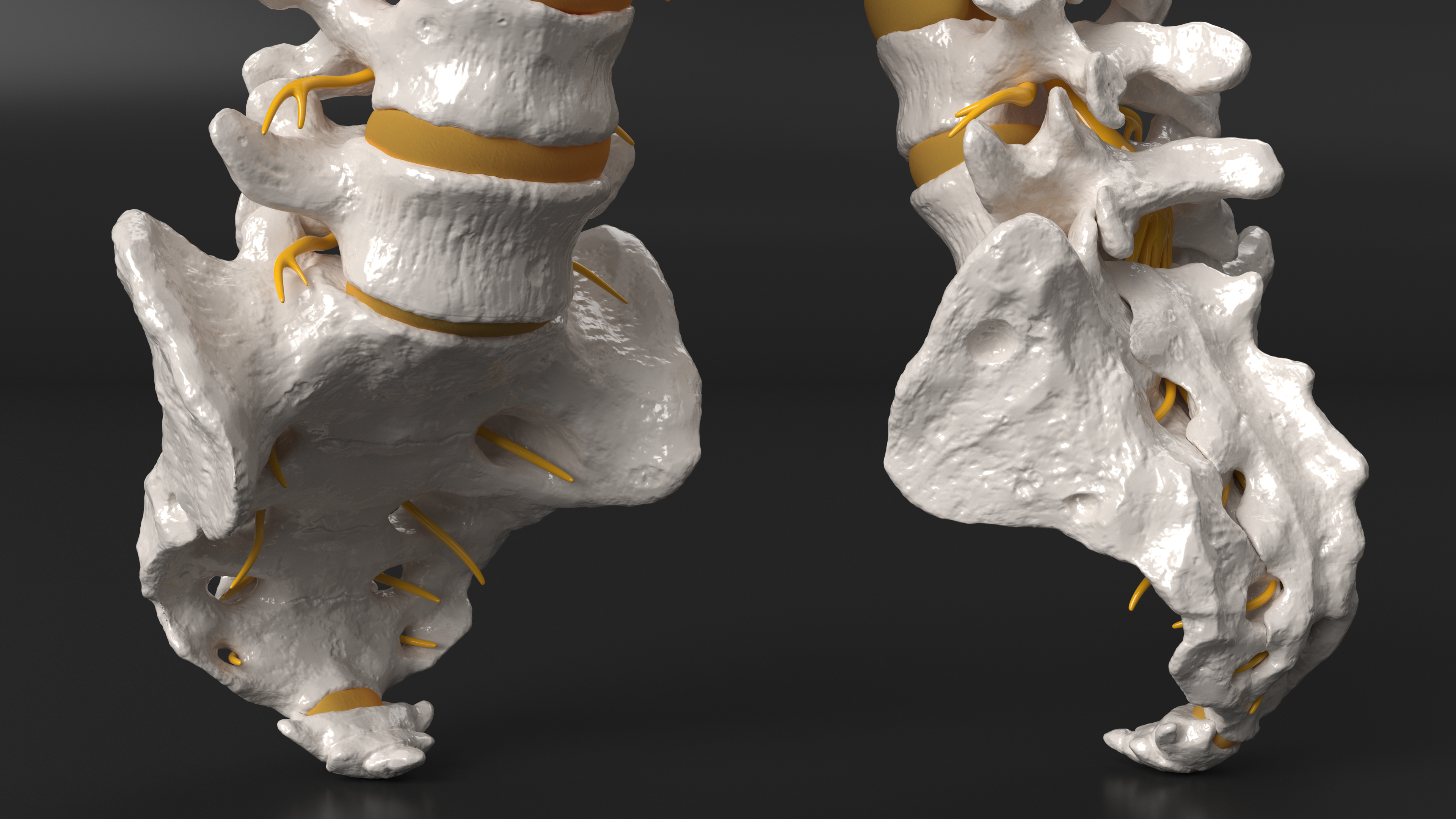 Spinal Column with Hernia, view 6