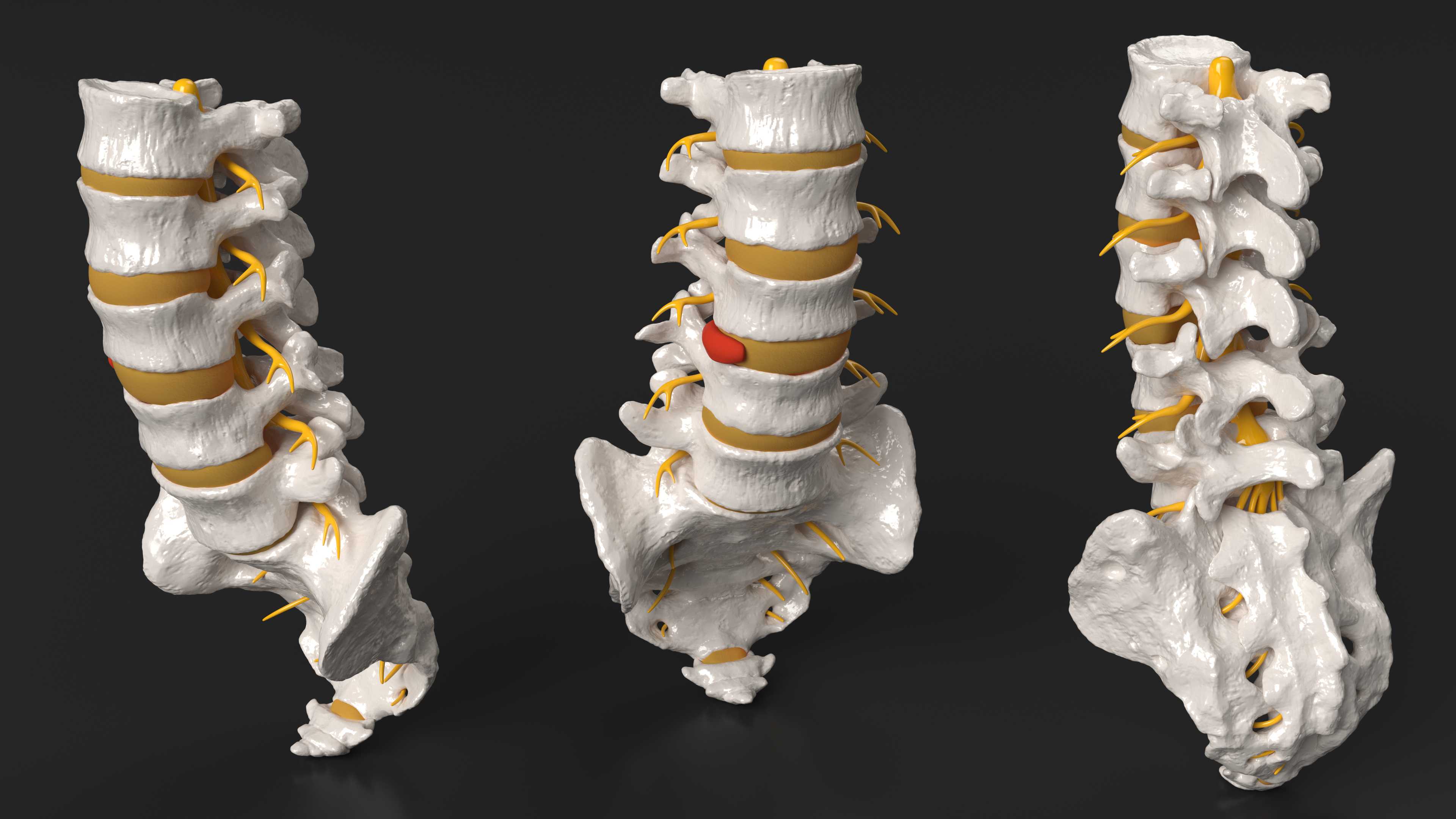 Spinal Column with Hernia, view 9