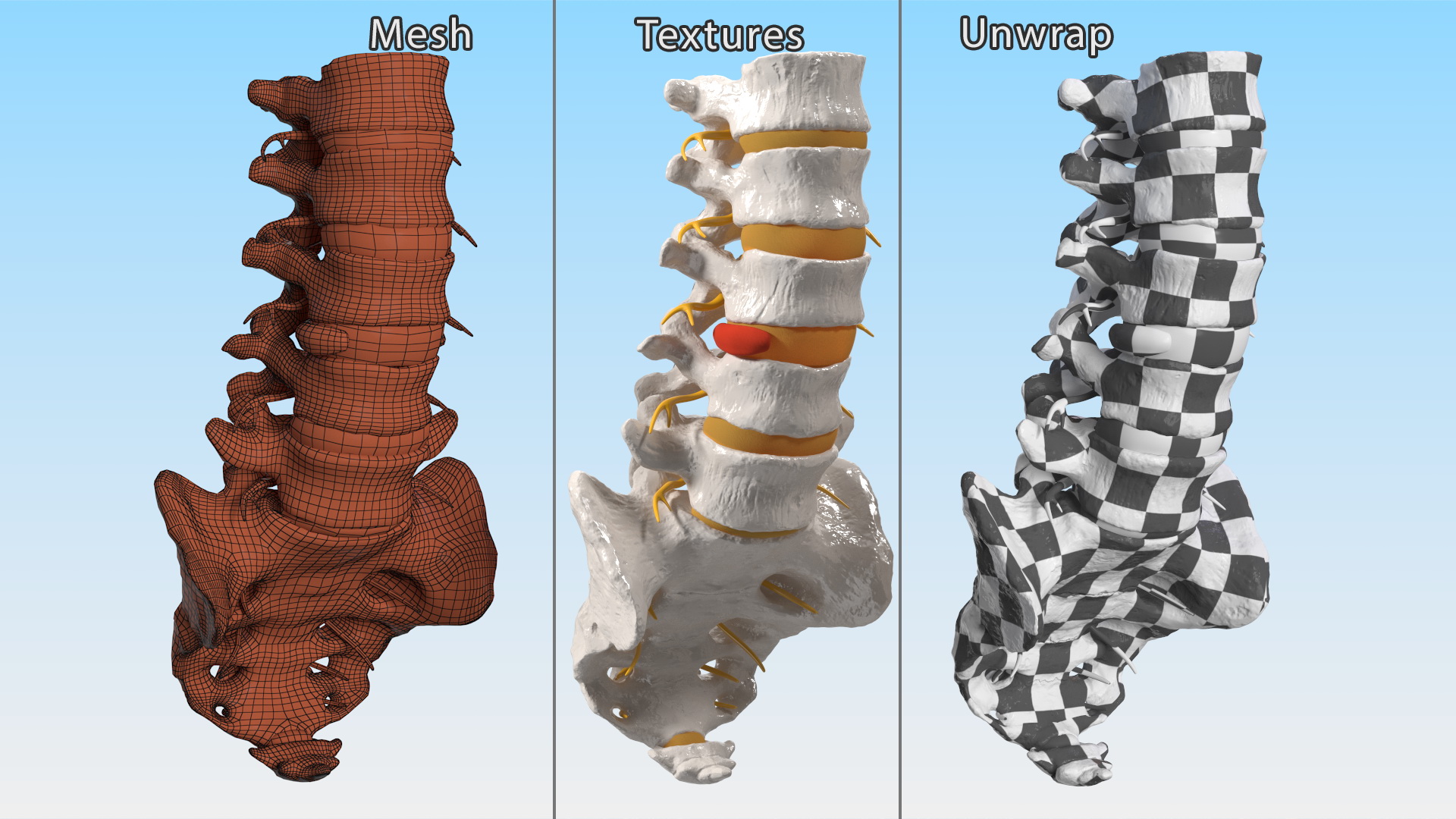 3D model Spinal Column with Hernia