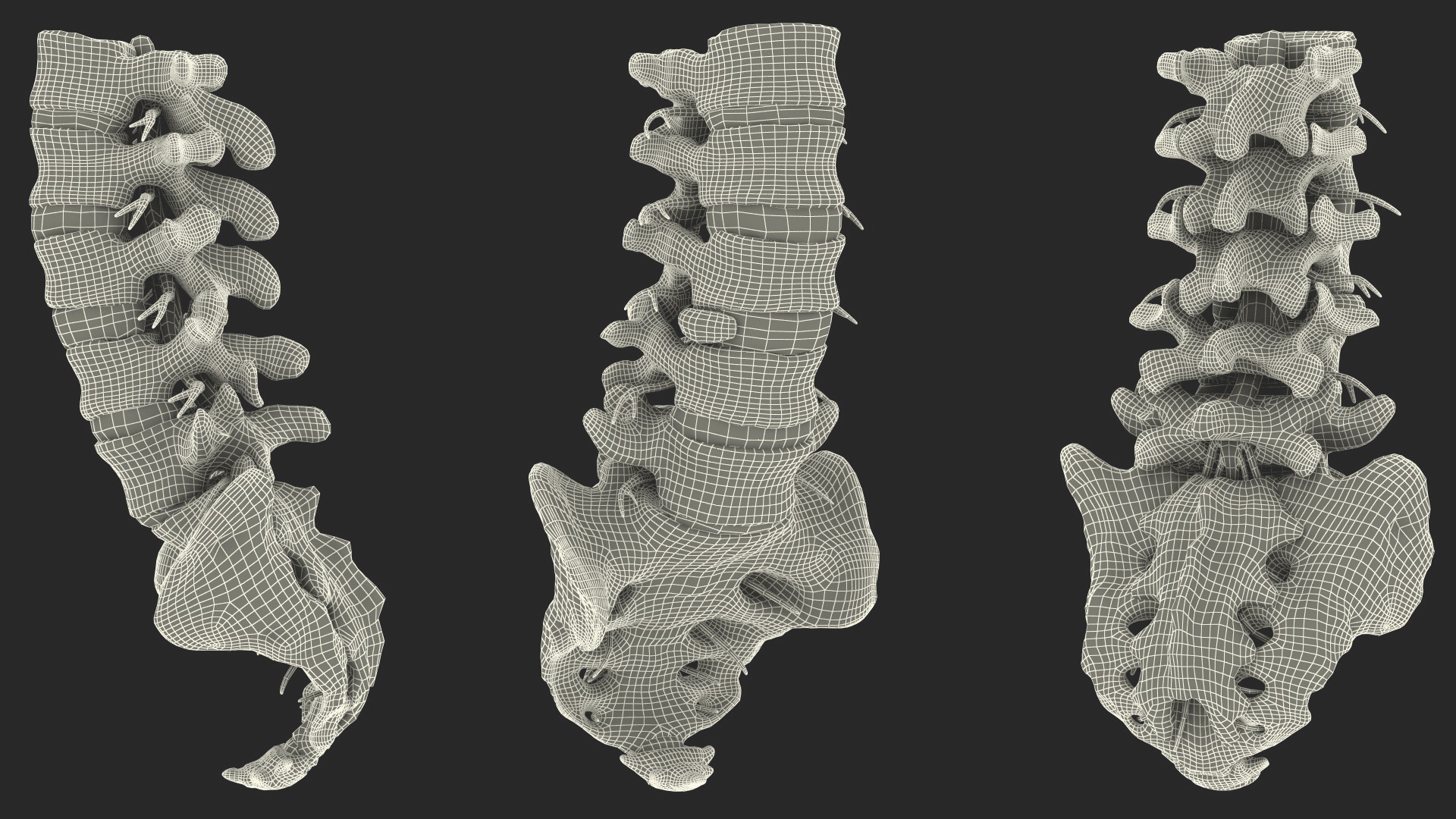 3D model Spinal Column with Hernia