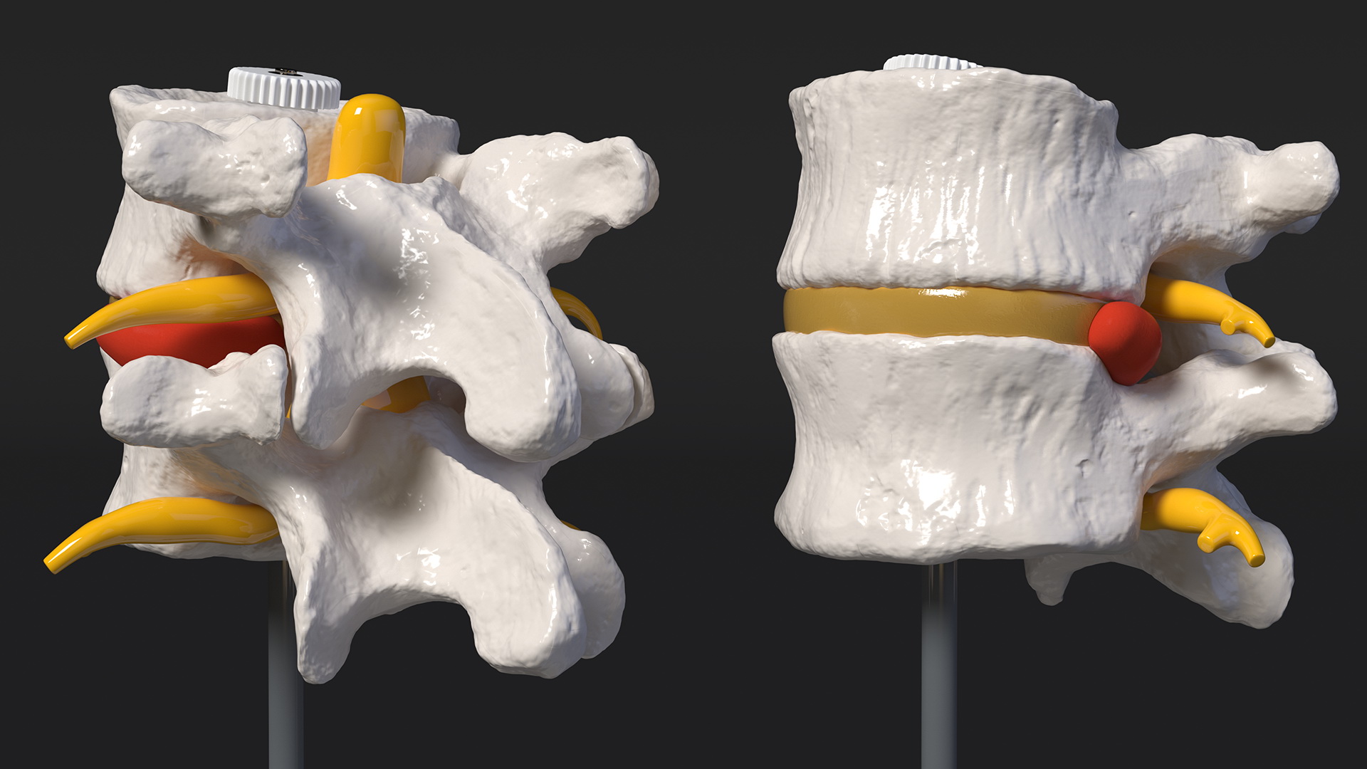 Stand with Herniated Spinal Vertebrae 3D