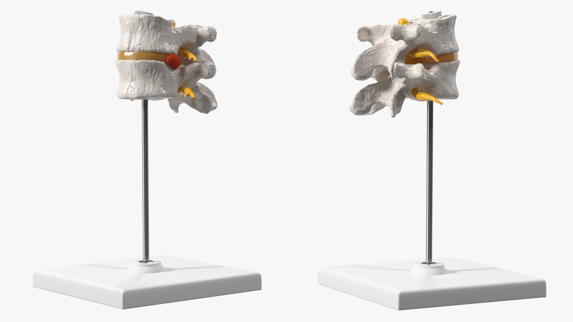 Stand with Herniated Spinal Vertebrae 3D