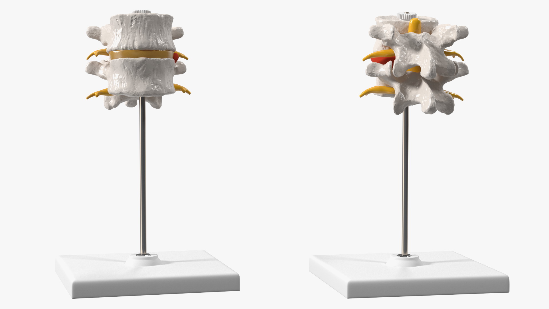 Stand with Herniated Spinal Vertebrae 3D