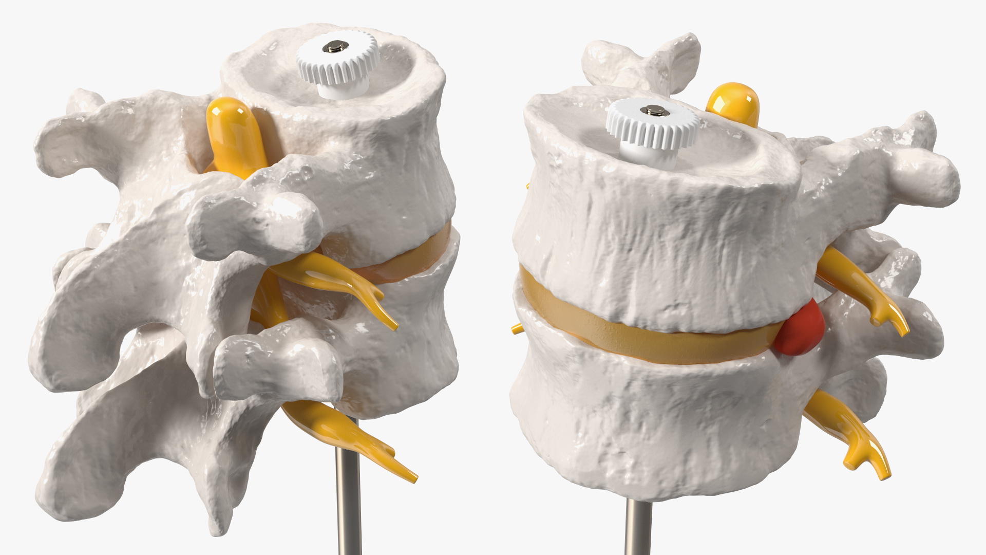 Stand with Herniated Spinal Vertebrae 3D