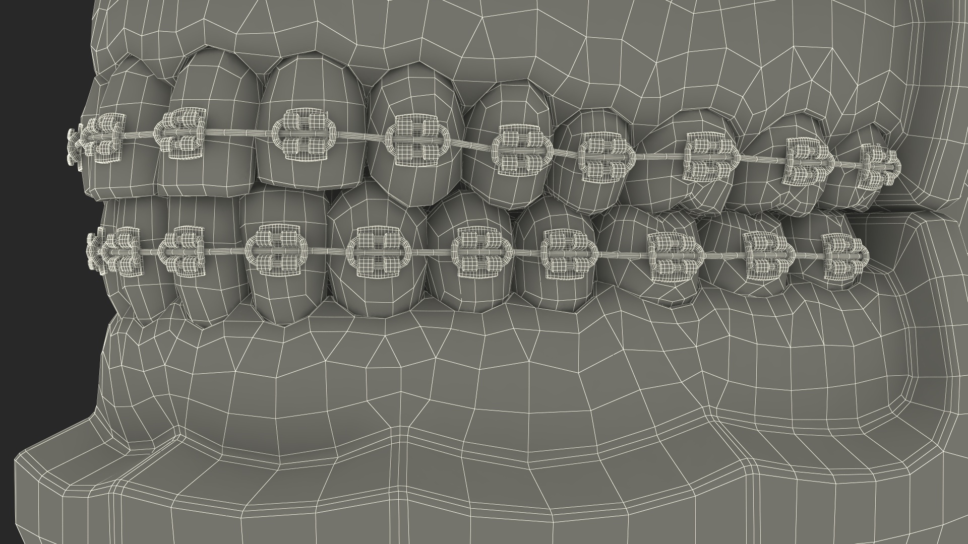 3D model Ligature Braces on Teeth Model