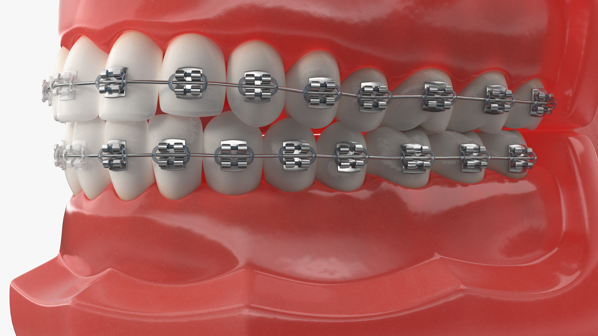 3D model Ligature Braces on Teeth Model