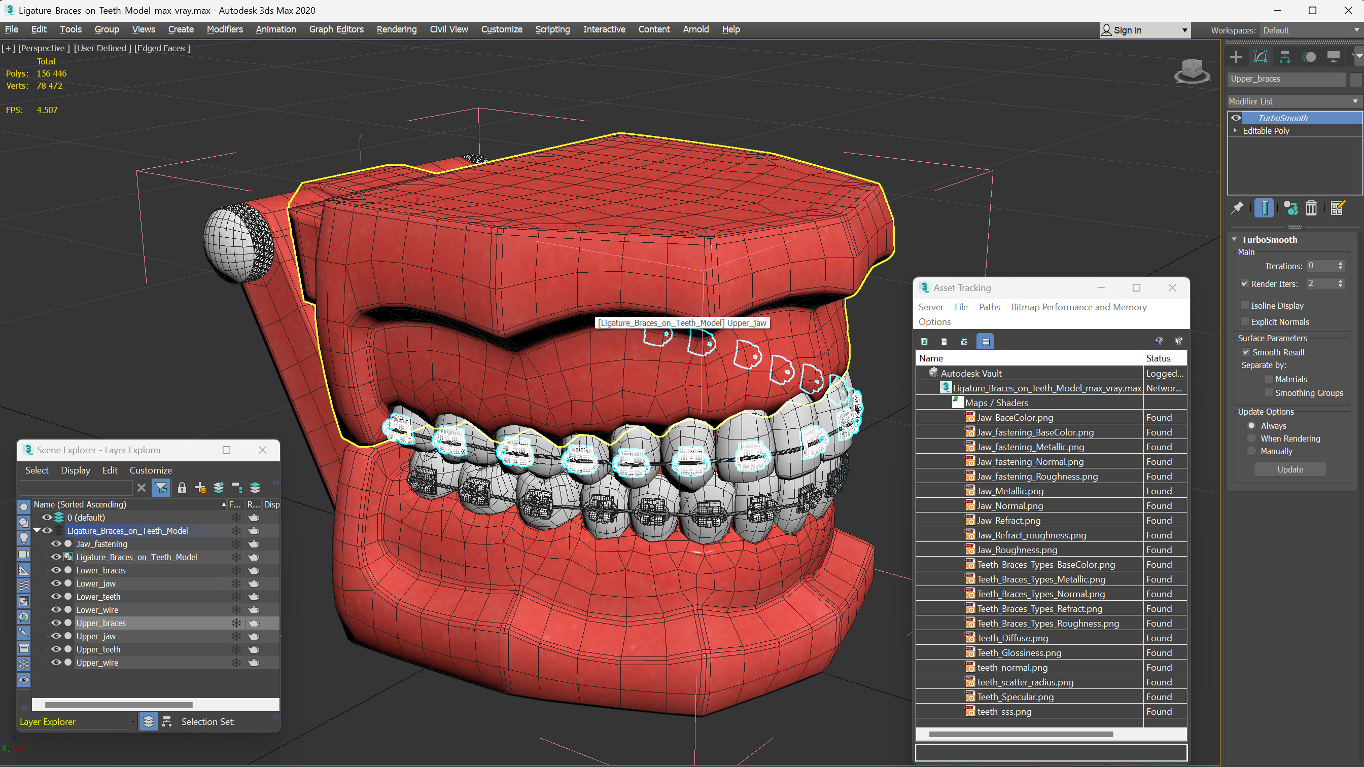 3D model Ligature Braces on Teeth Model