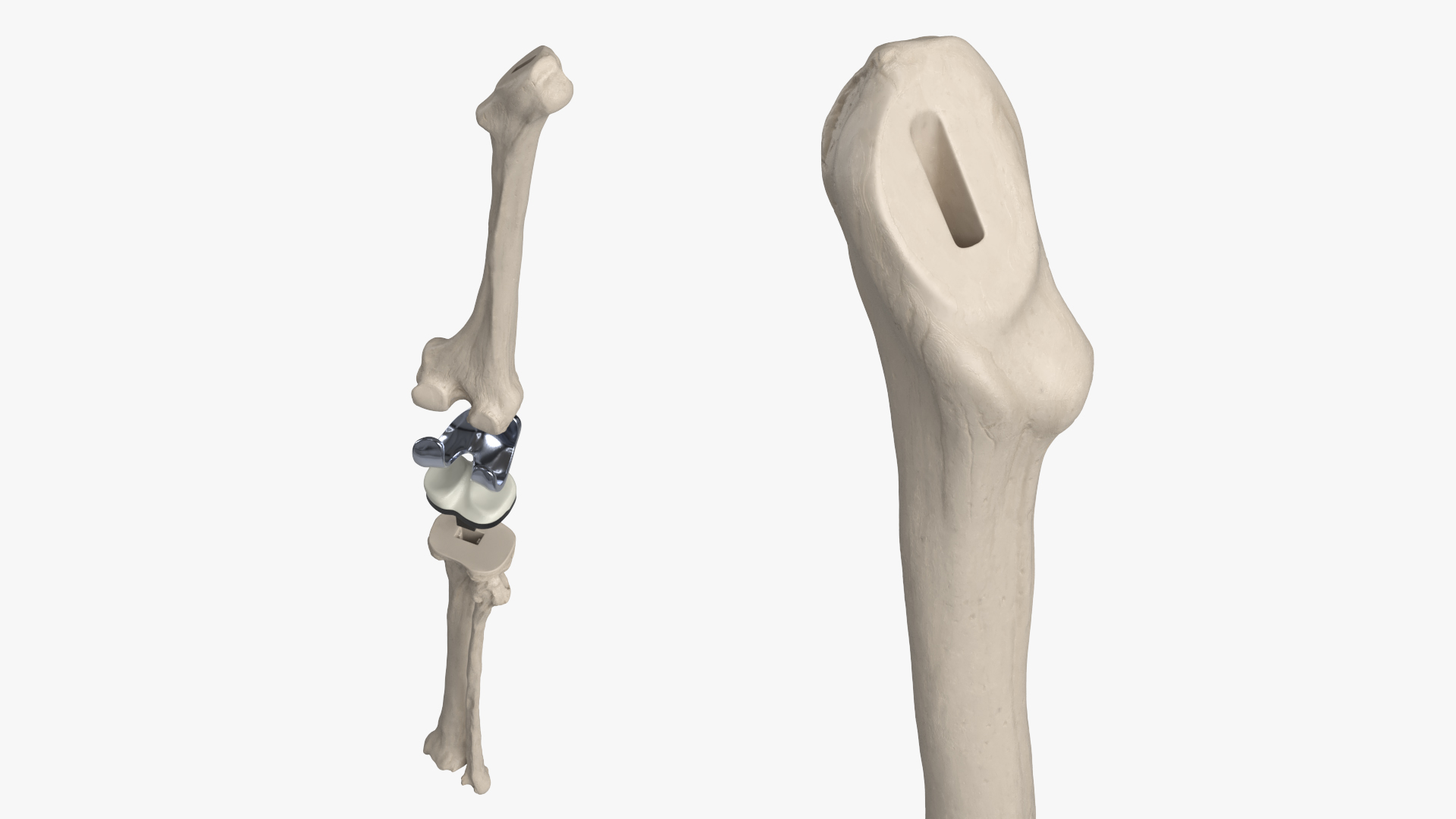 Knee Joint Implant with Femur Tibia and Fibula, view 5