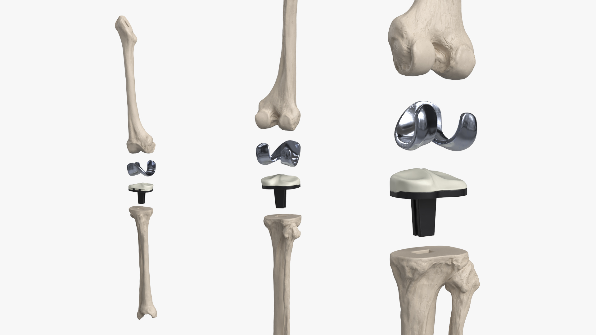 Knee Joint Implant with Femur Tibia and Fibula, view 3
