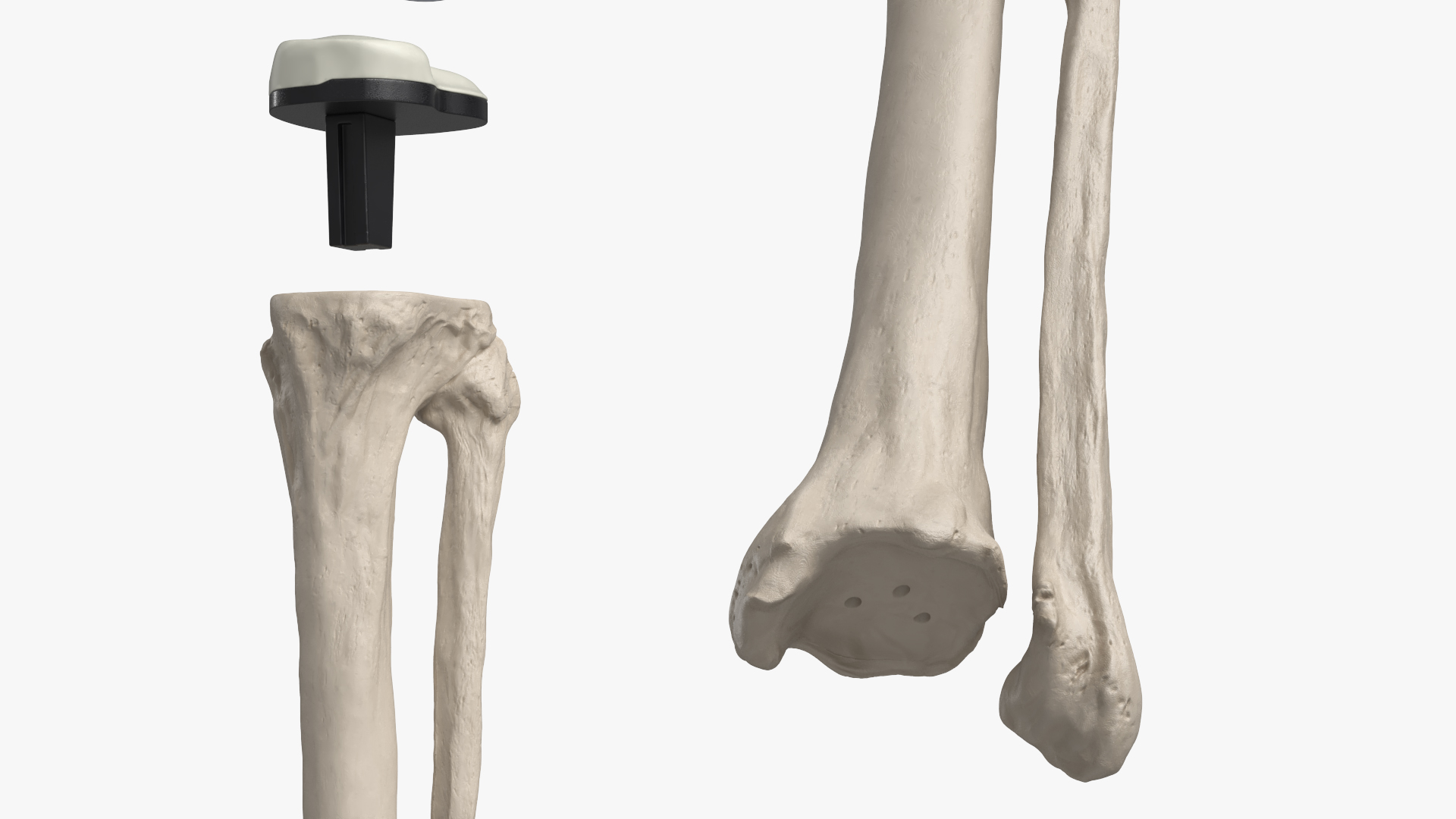 Knee Joint Implant with Femur Tibia and Fibula, view 4