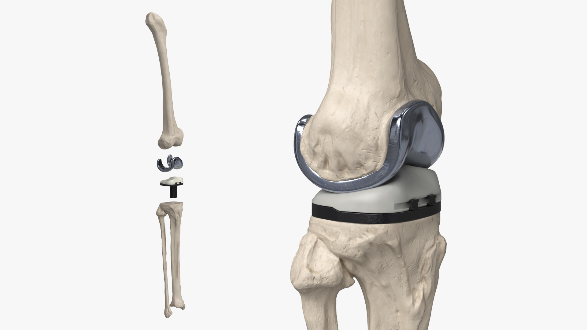 Knee Joint Implant with Femur Tibia and Fibula