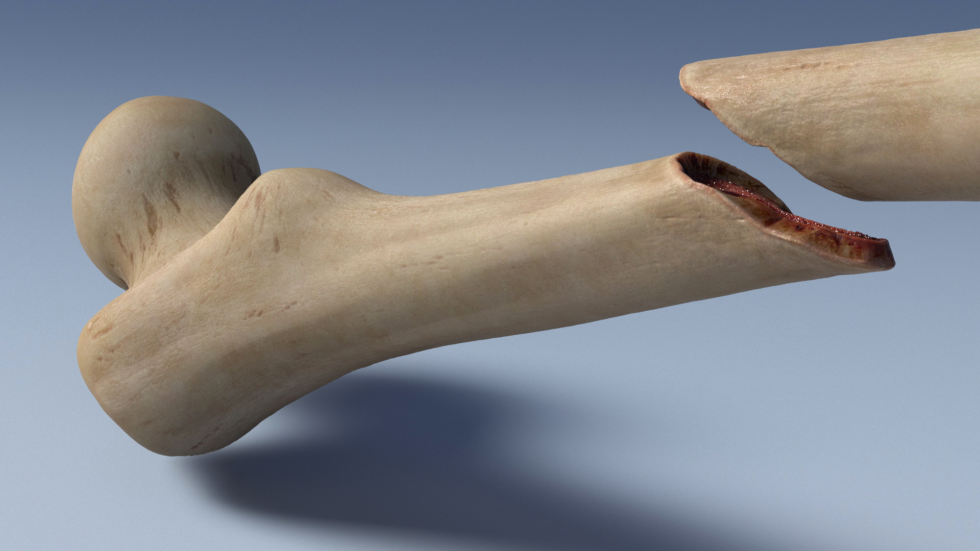 Bone Fracture Types Set - view 4