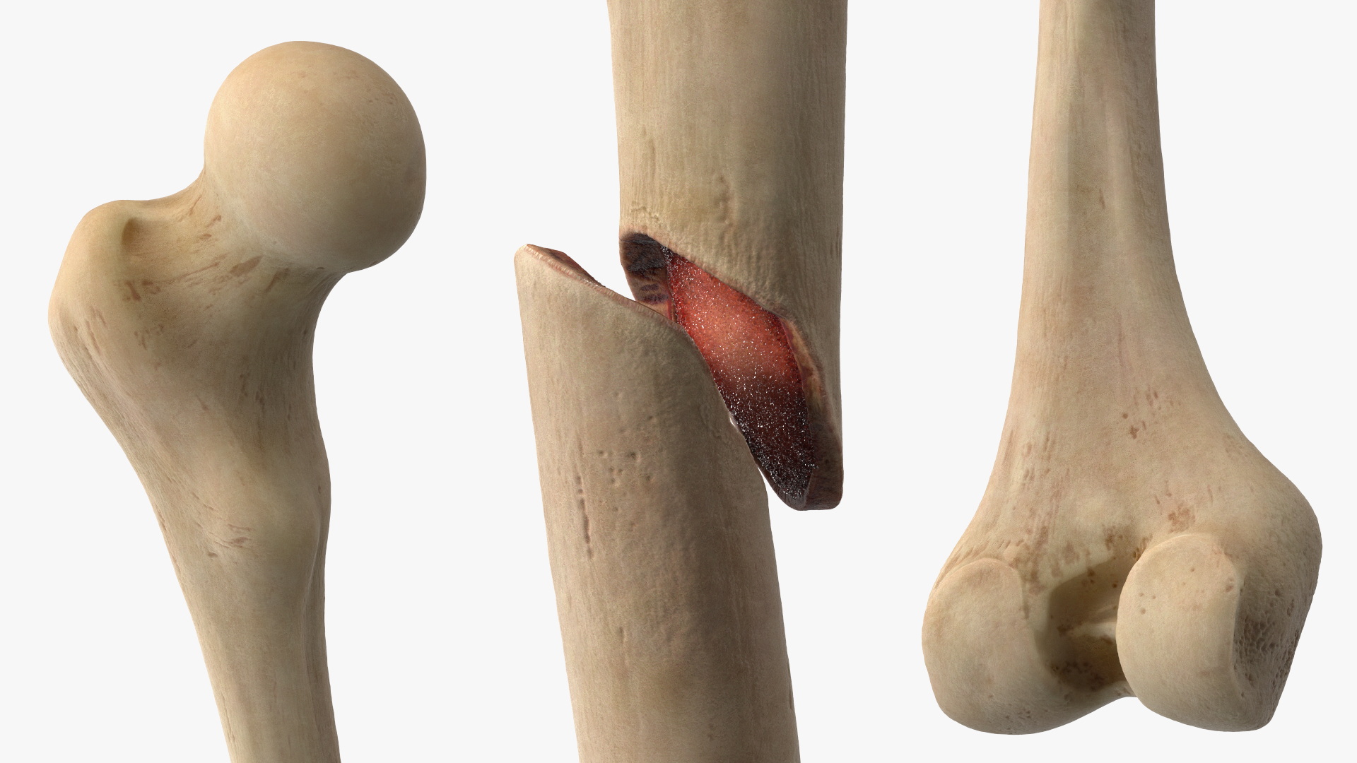 Bone Fracture Types Set - view 7