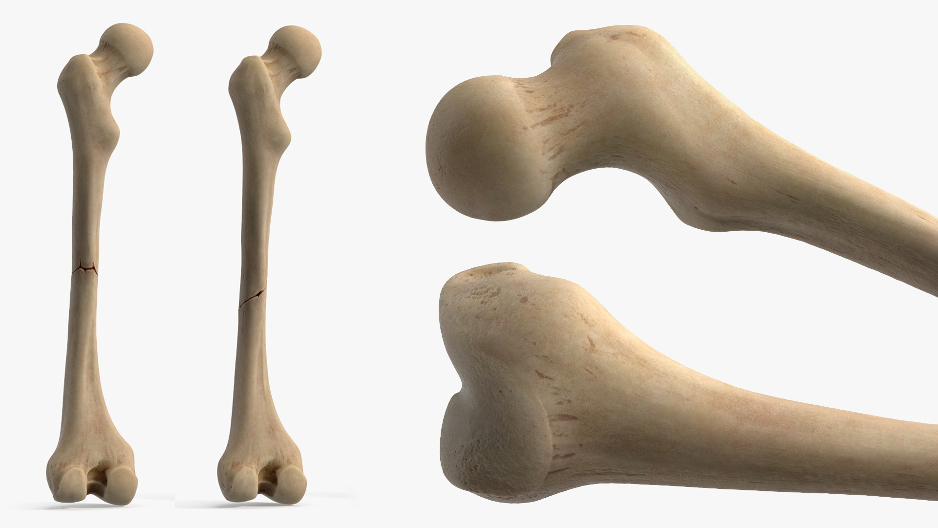 Bone Fracture Types Set - view 8