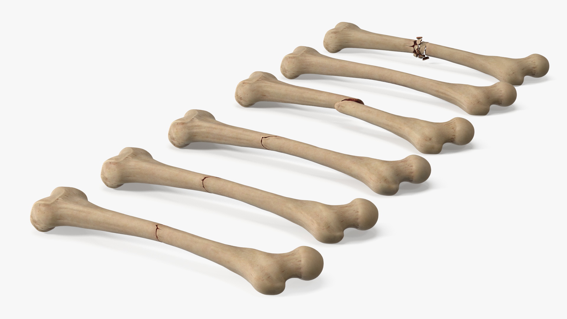 Bone Fracture Types Set - view 5