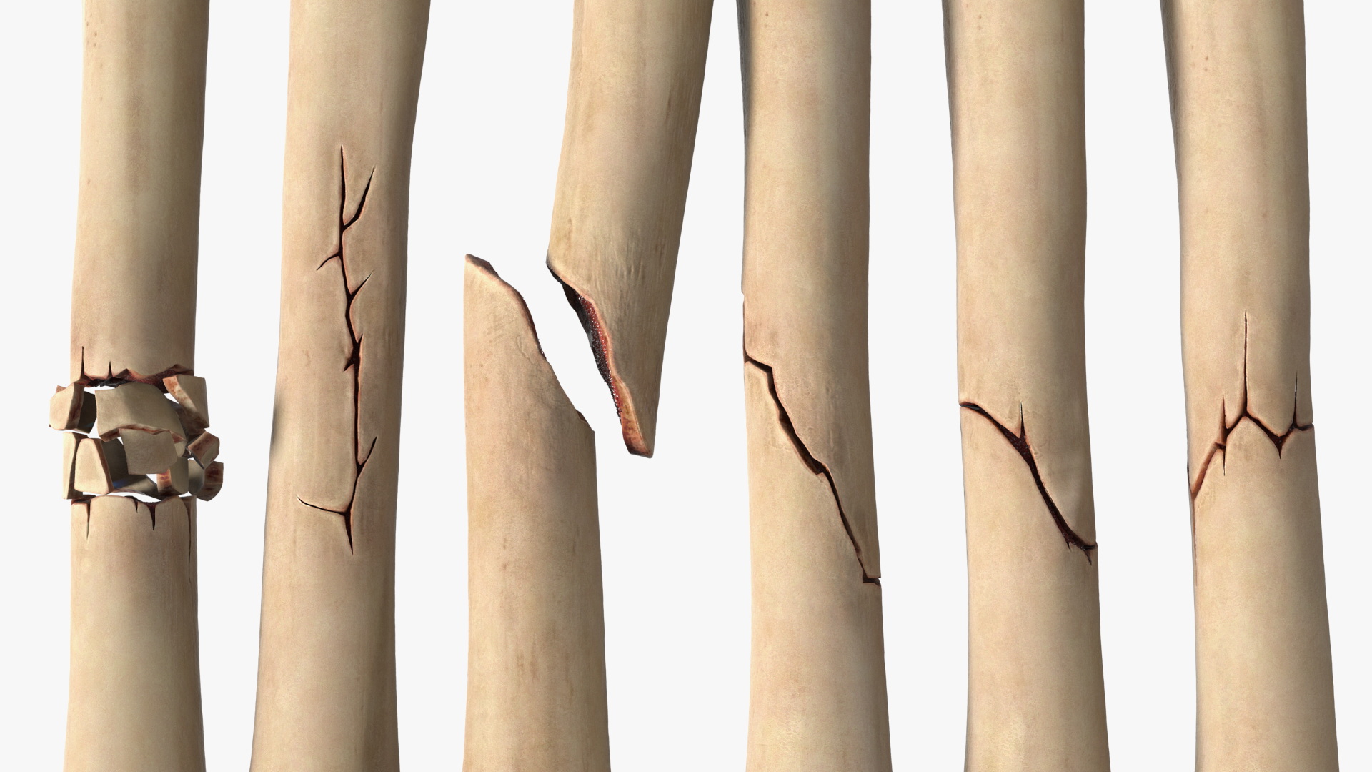 Bone Fracture Types Set - view 6