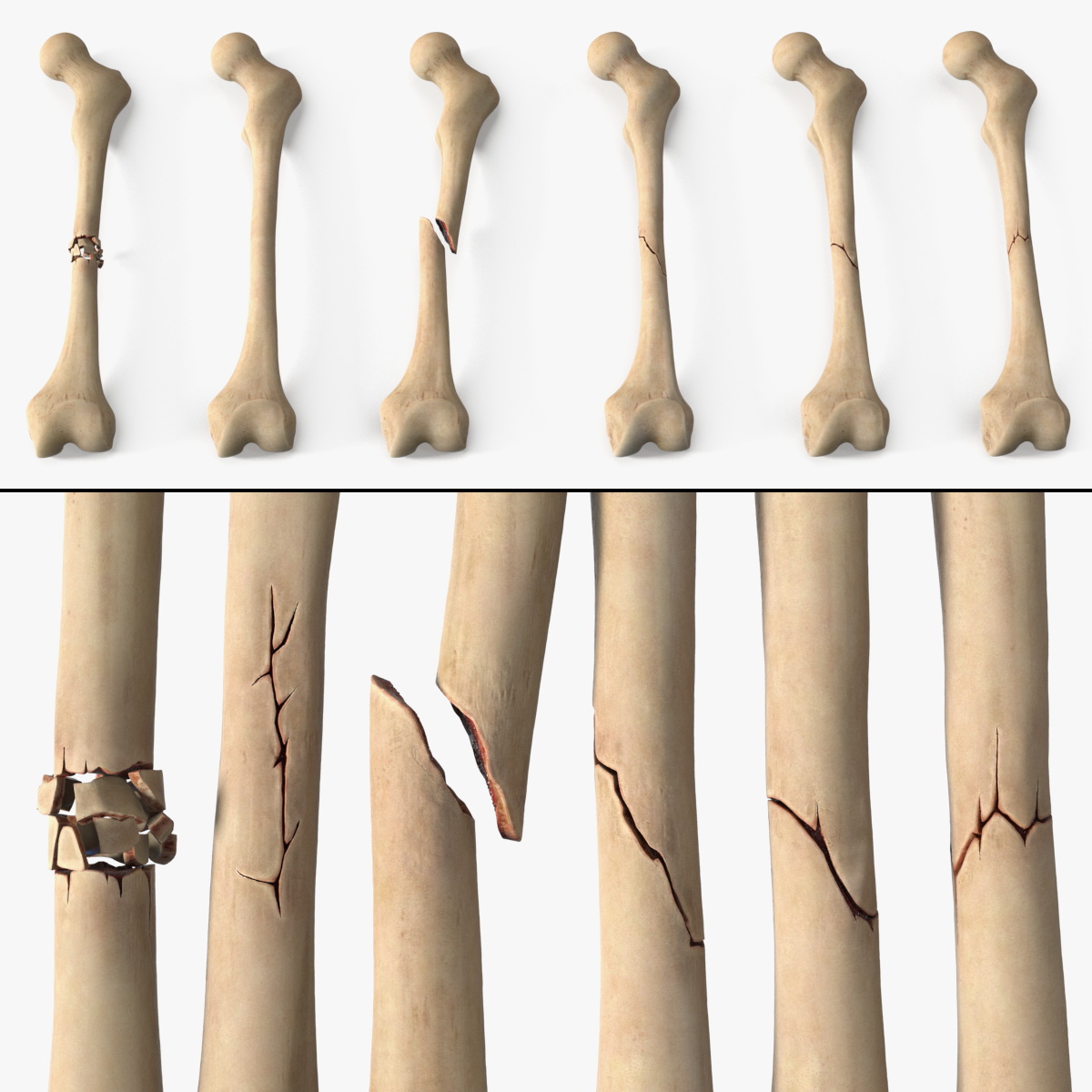Bone Fracture Types Set 3D model preview