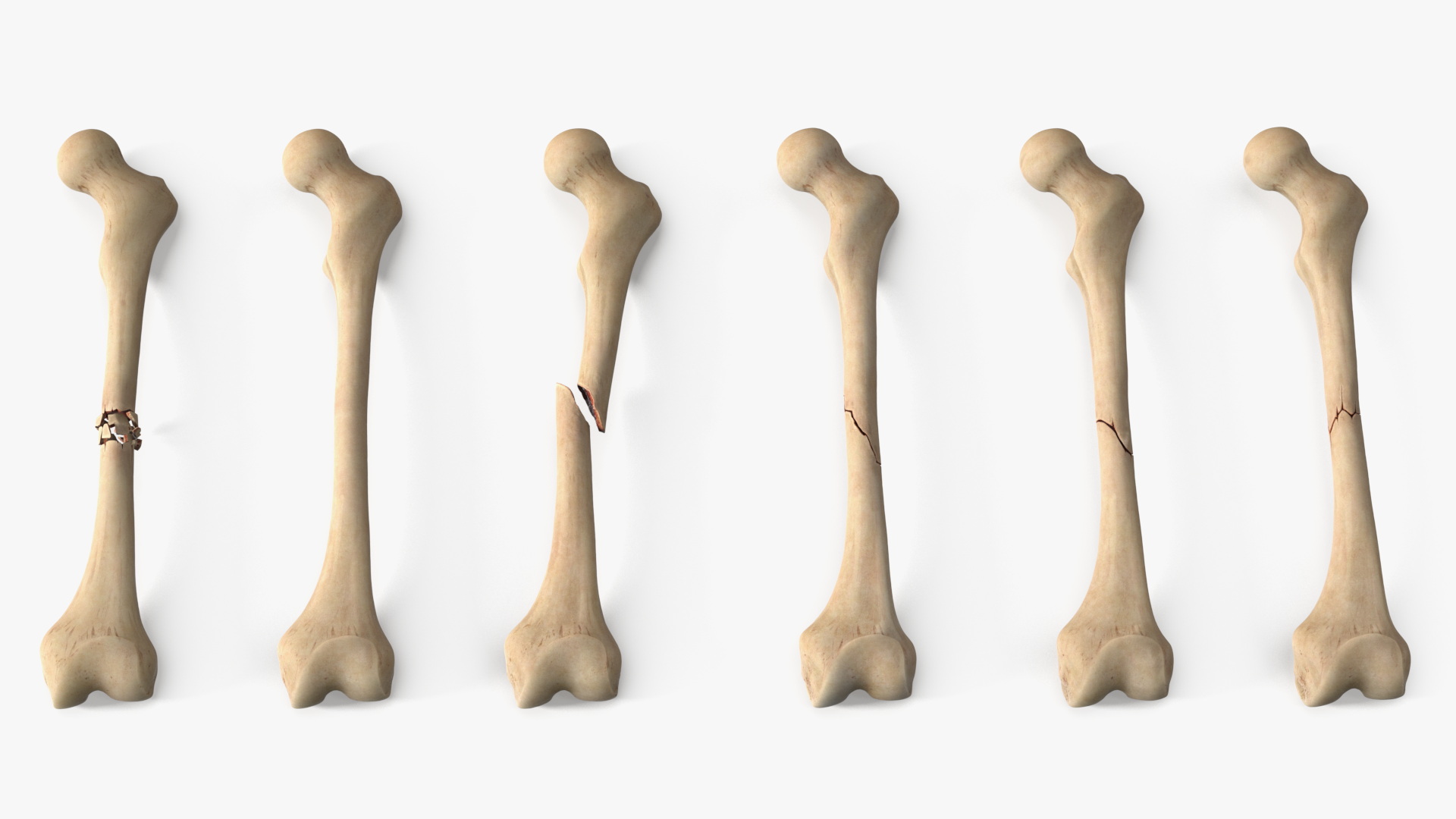 Bone Fracture Types Set - view 2