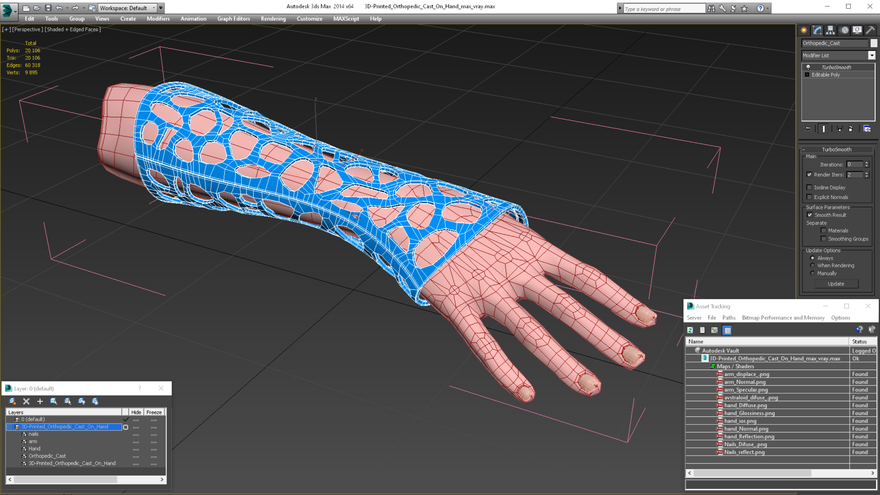 3D-Printed Orthopedic Cast On Hand 3D model