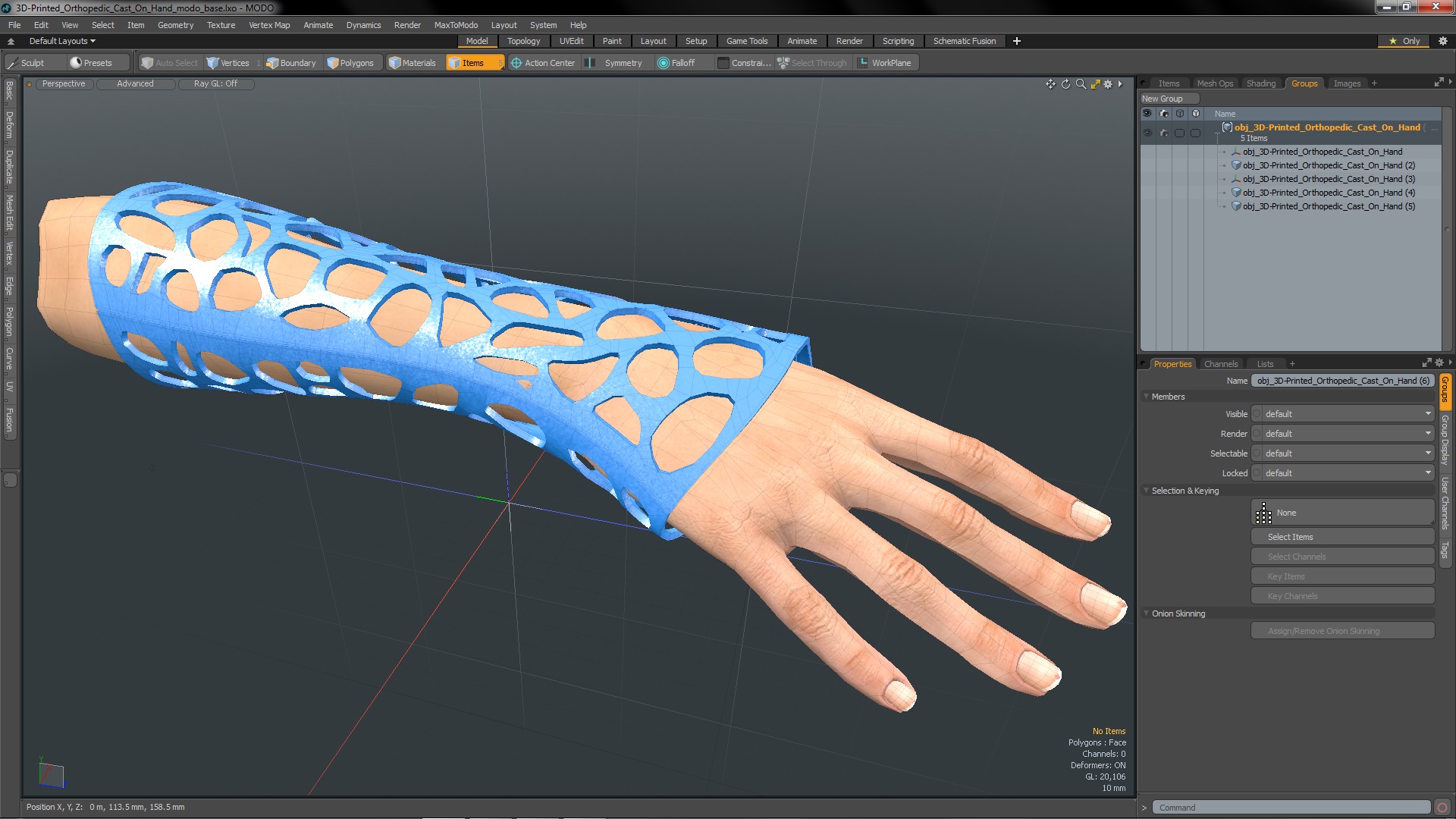 3D-Printed Orthopedic Cast On Hand 3D model