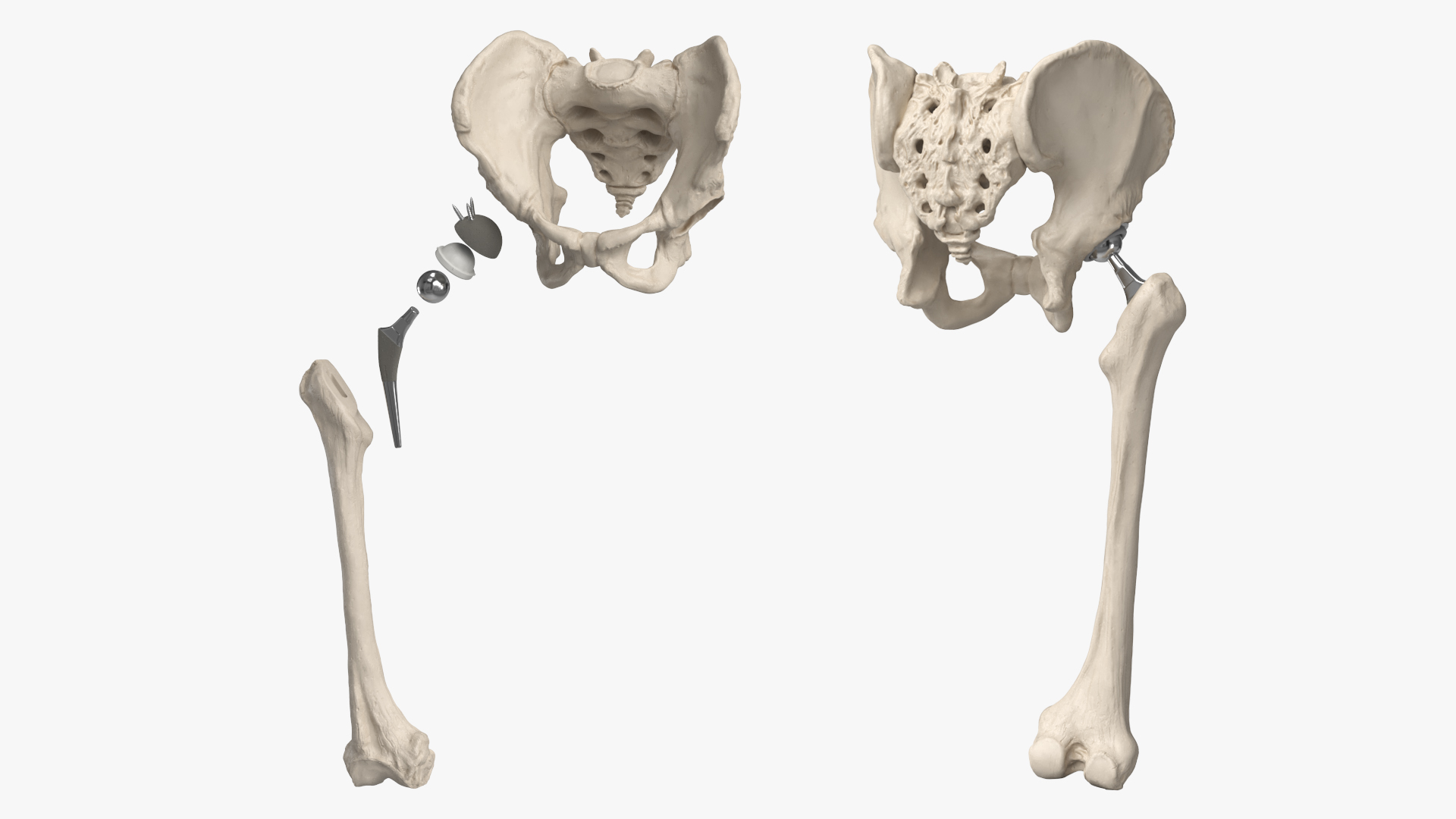 Hip Joint Implant with Pelvic Bone and Femur