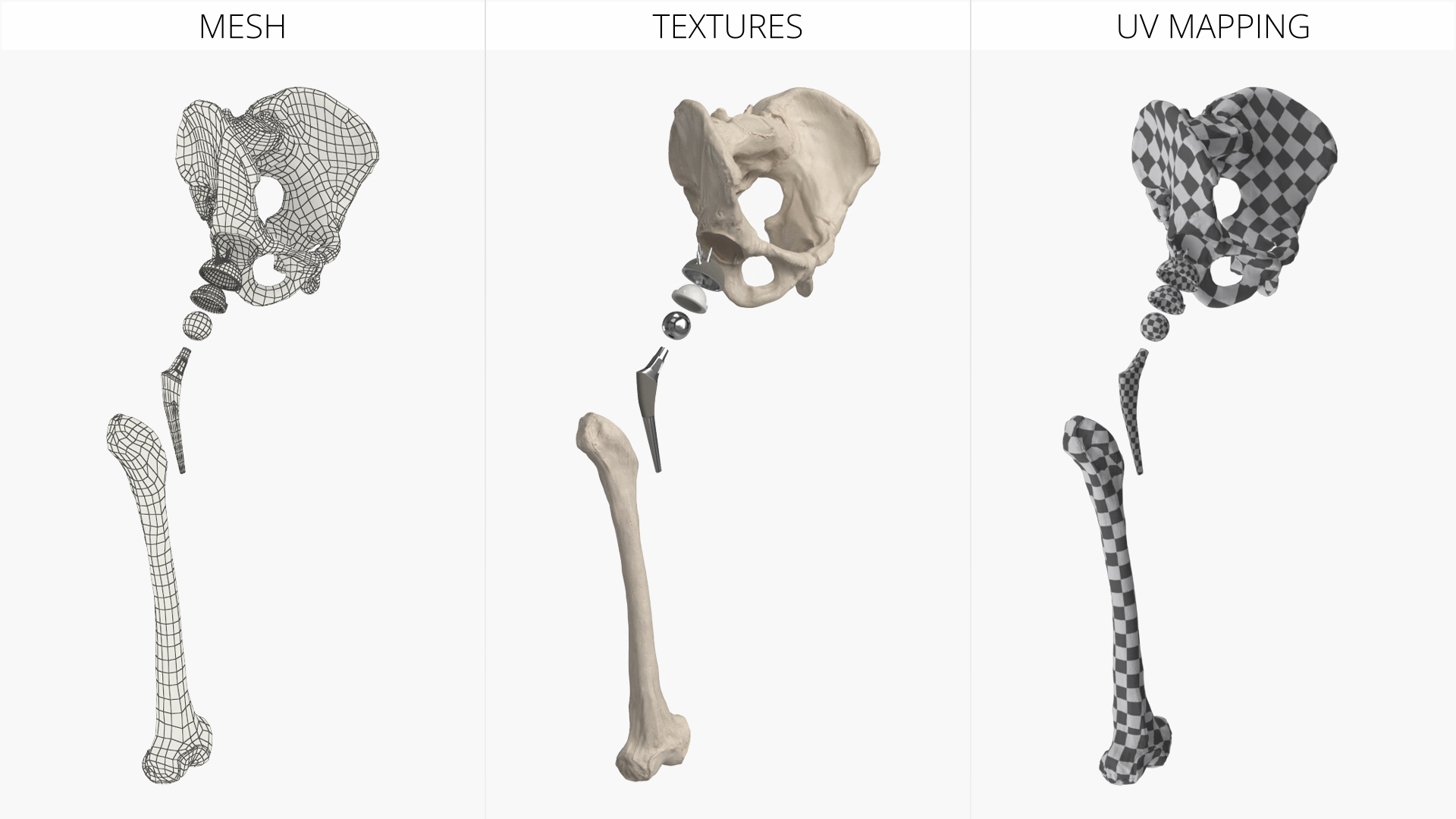 Hip Joint Implant with Pelvic Bone and Femur, view 7