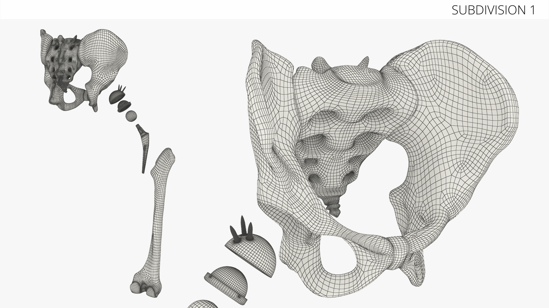 Hip Joint Implant with Pelvic Bone and Femur, view 9