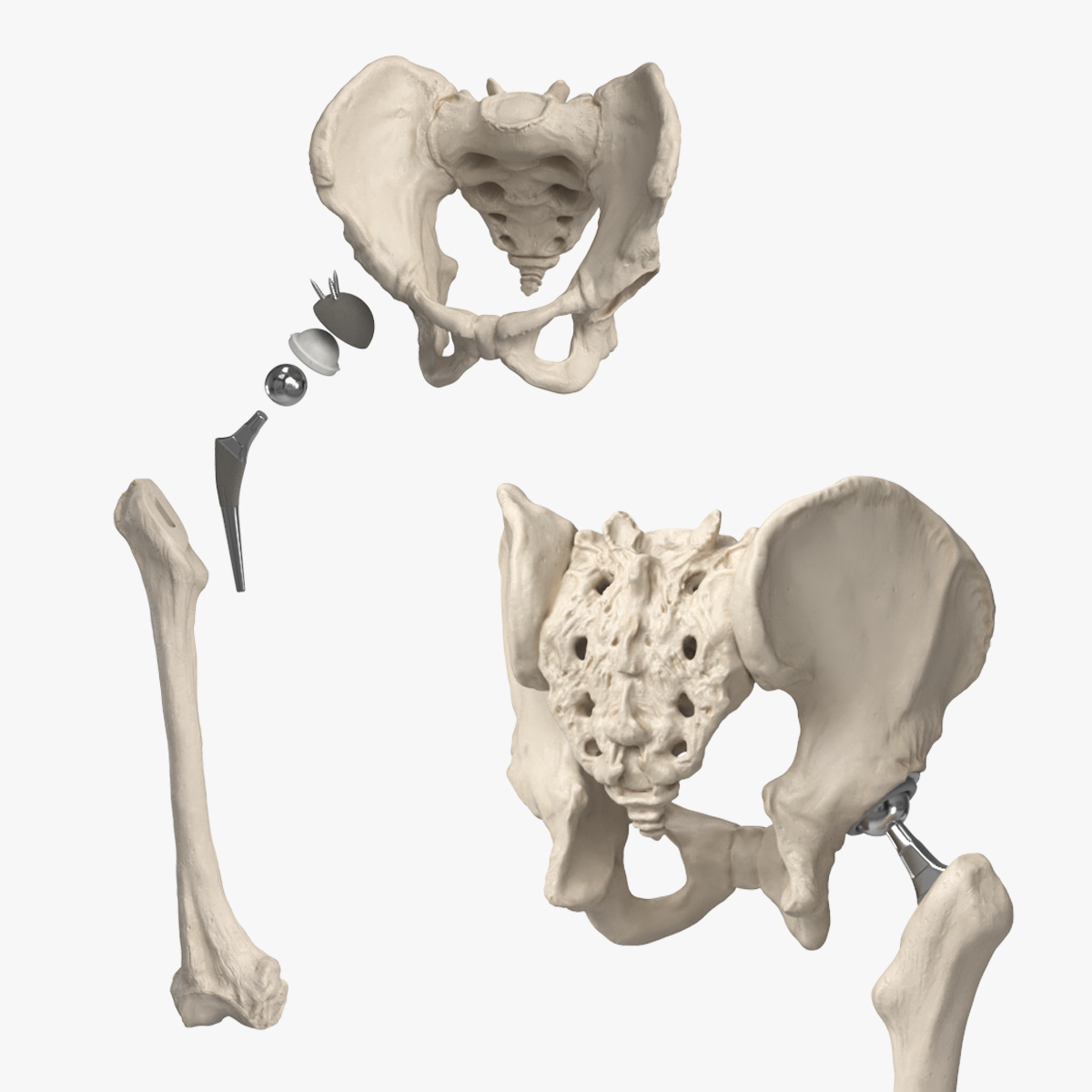 Hip Joint Implant with Pelvic Bone and Femur
